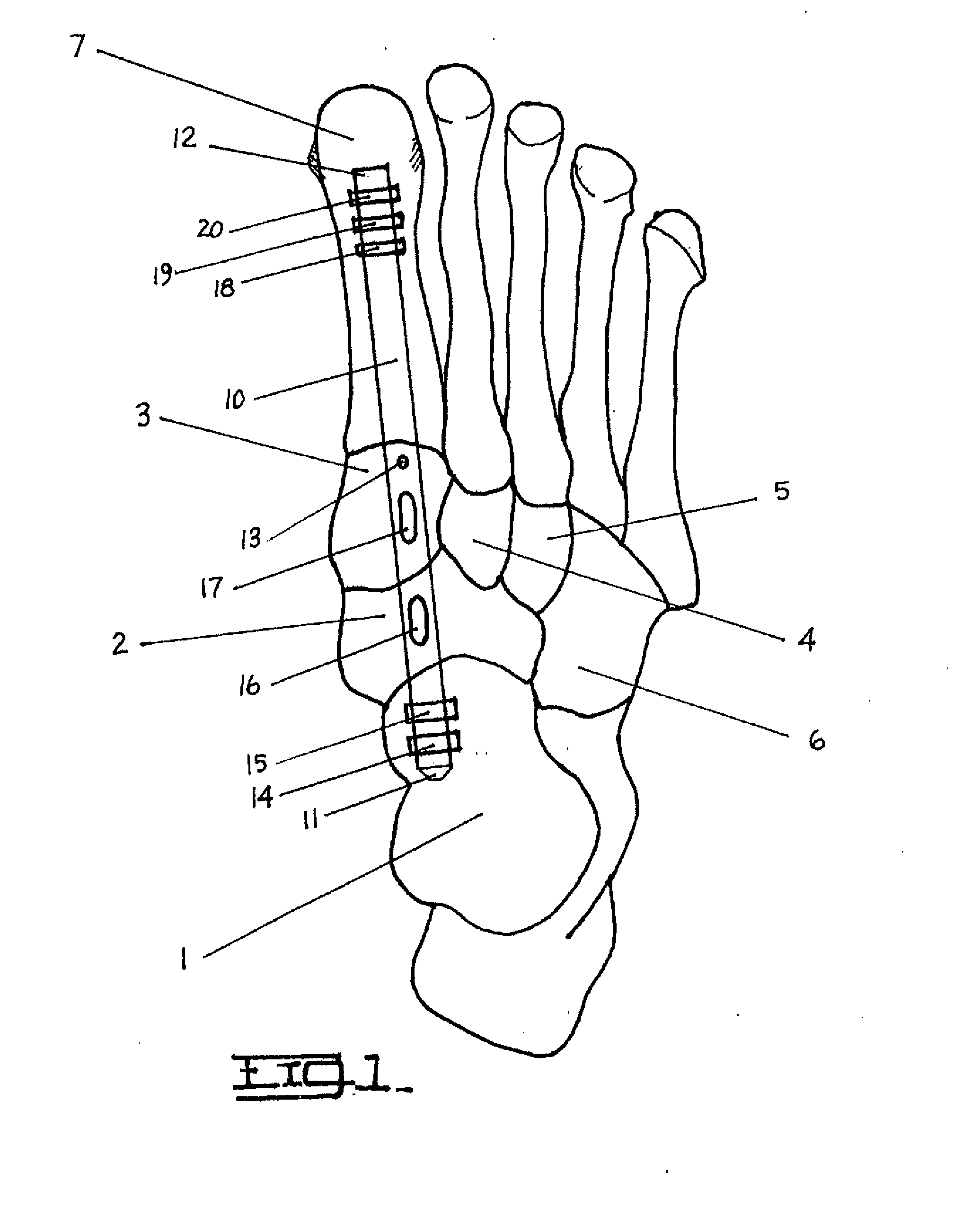 Method and Apparatus for Repairing the Mid-Foot Region Via and Intramedullary Nail