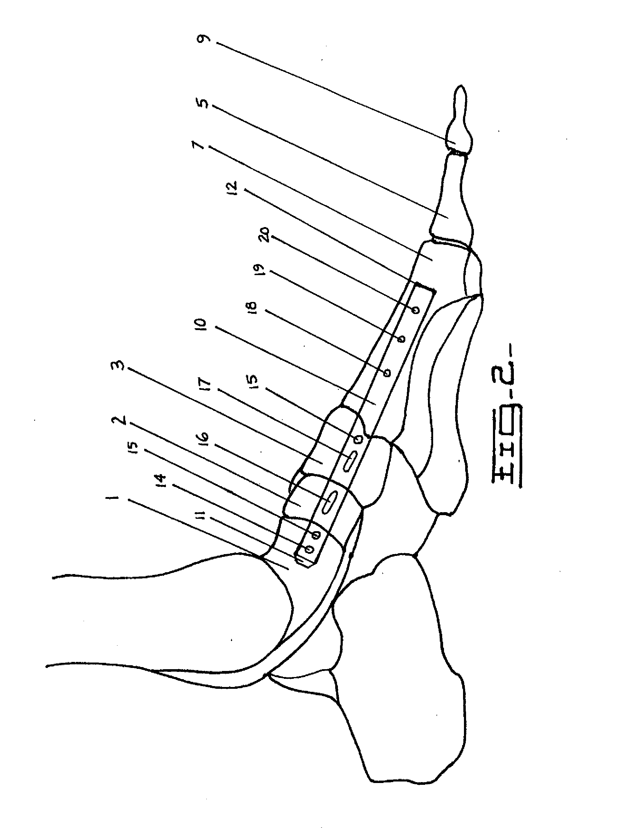 Method and Apparatus for Repairing the Mid-Foot Region Via and Intramedullary Nail