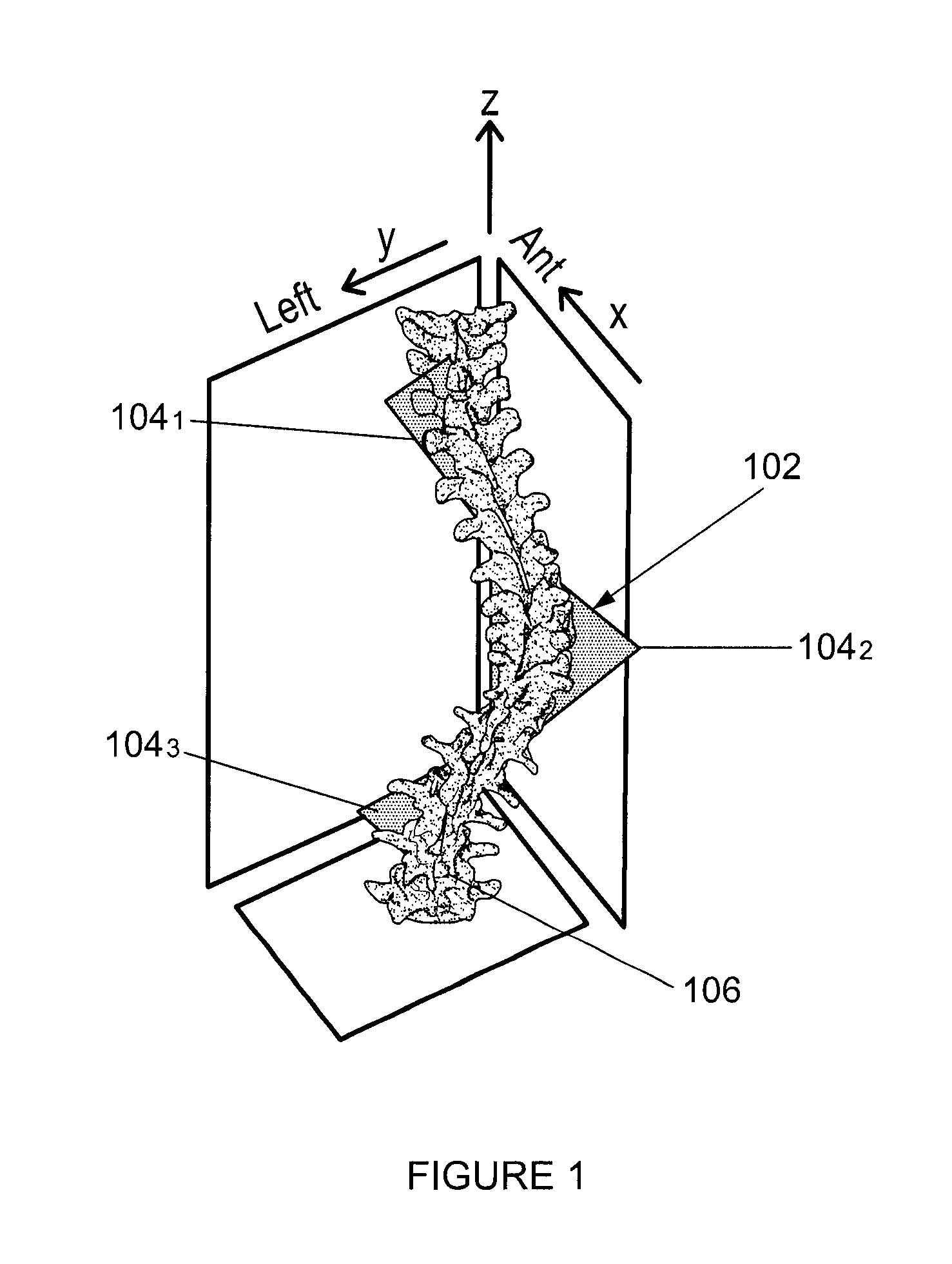 System and method for predicting scoliosis progression