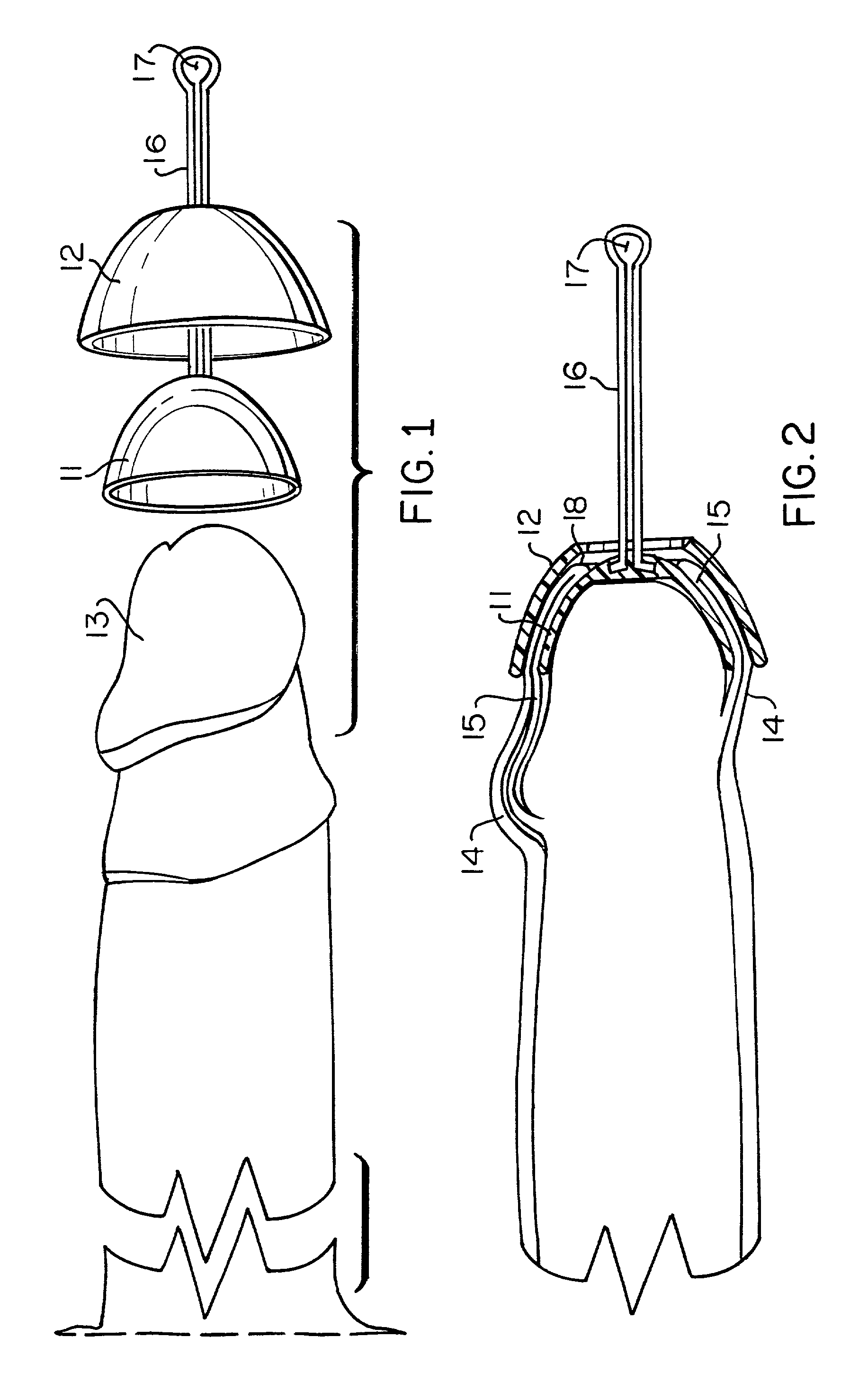 Foreskin restoration device