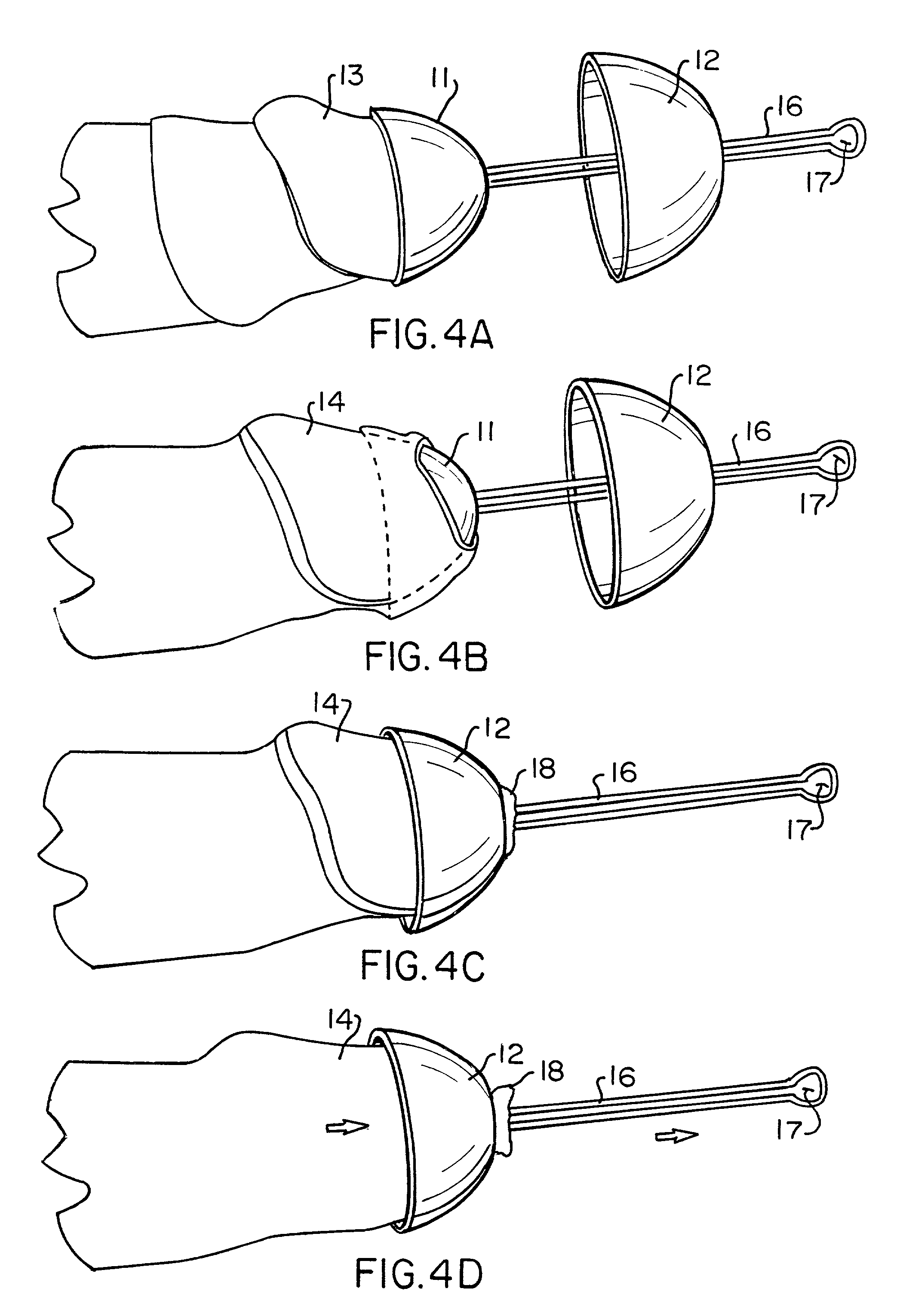 Foreskin restoration device