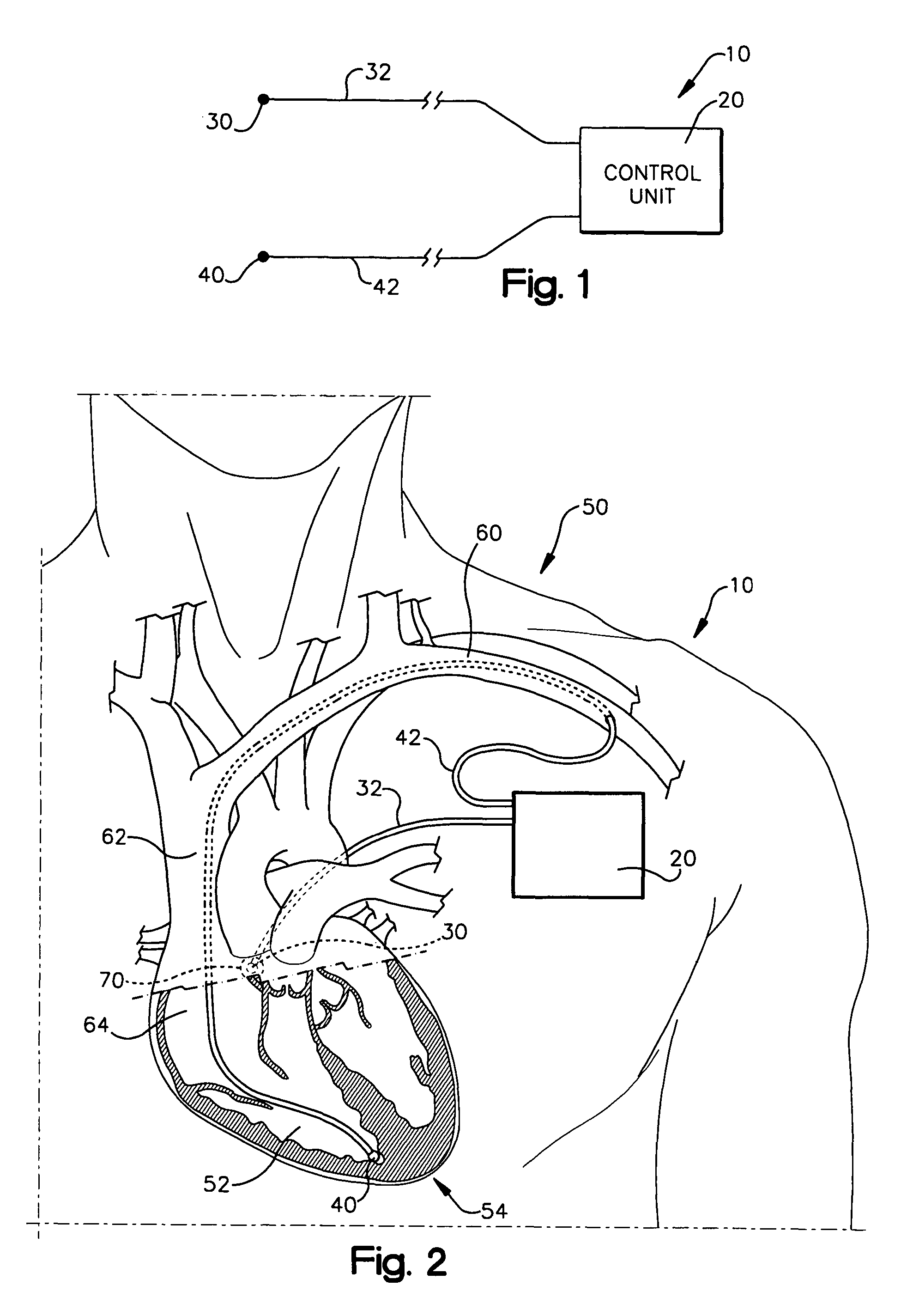 System and method for achieving regular slow ventricular rhythm in response to atrial fibrillation