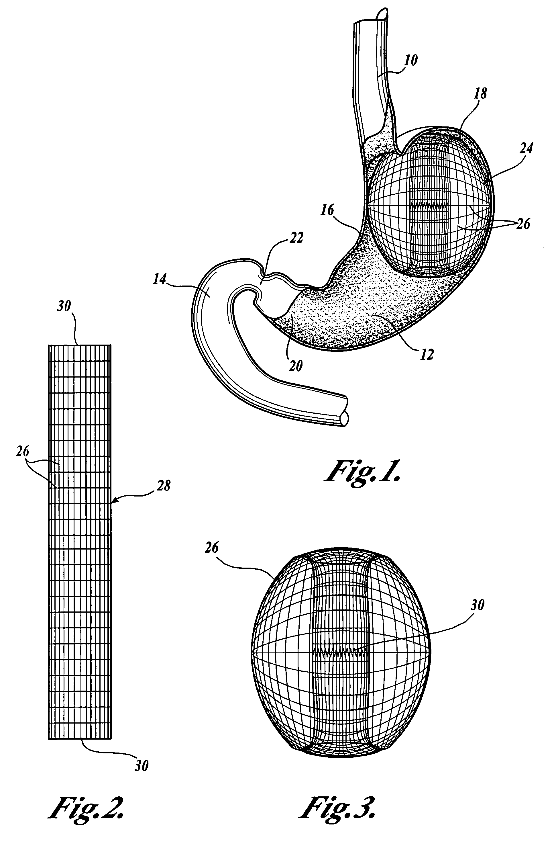 Intragastric prosthesis for the treatment of morbid obesity