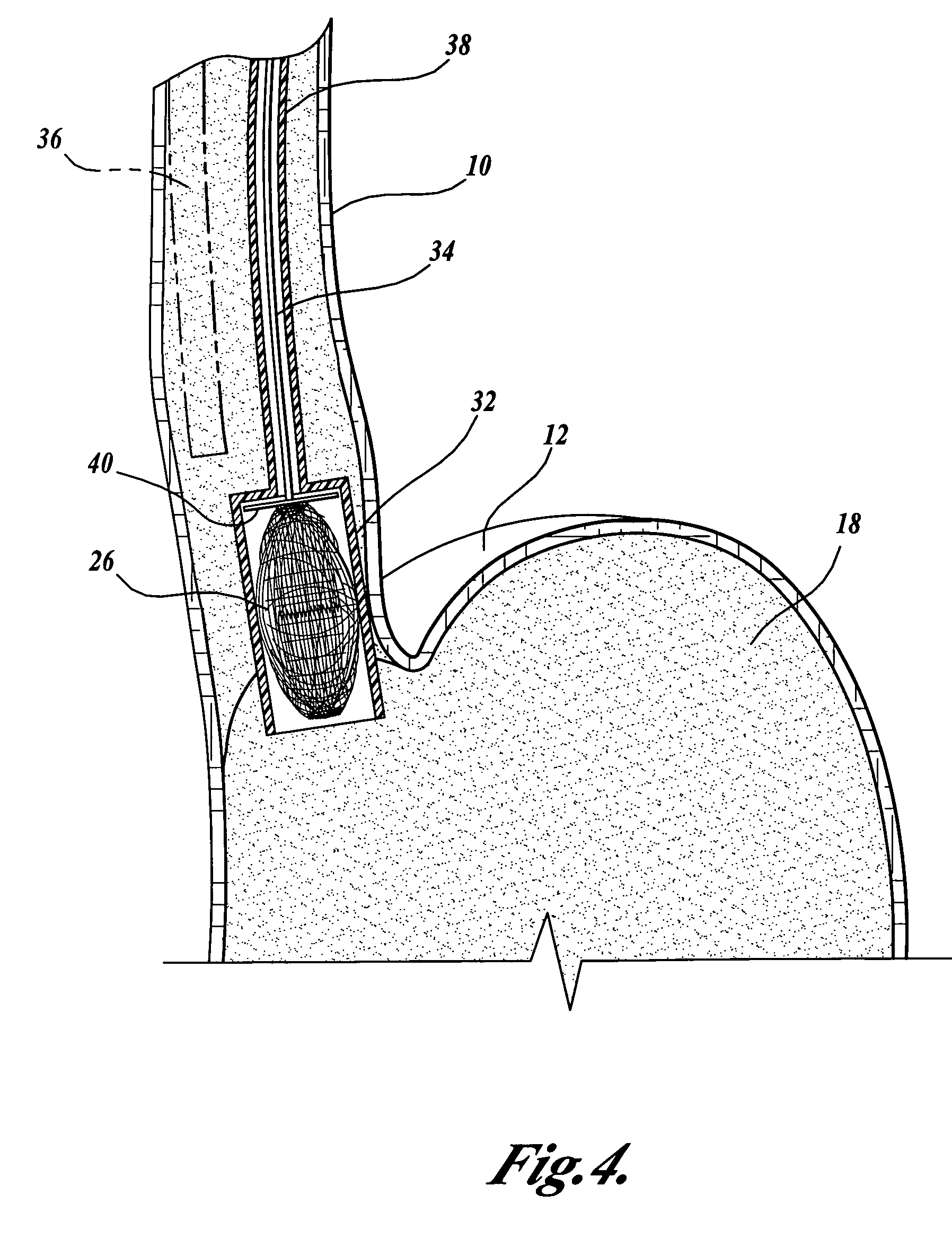 Intragastric prosthesis for the treatment of morbid obesity