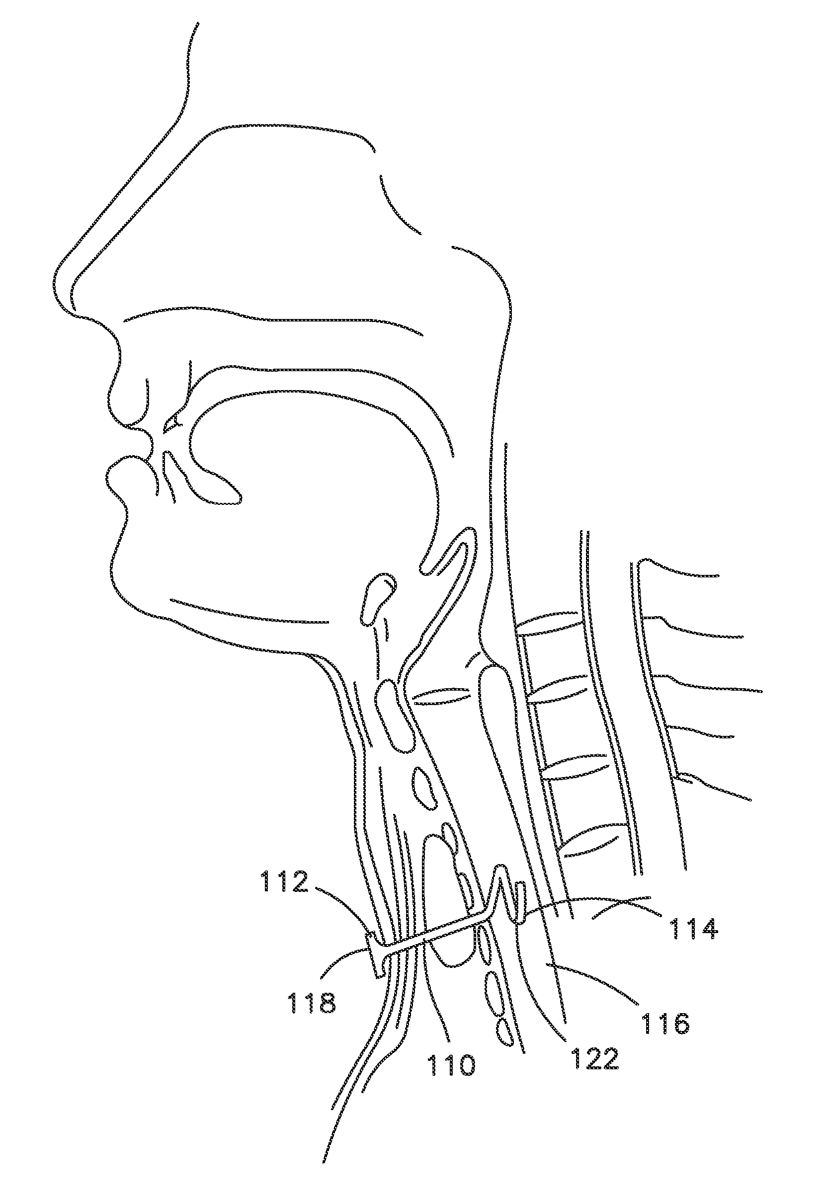 Tracheostomy Appliances and Methods for the Treatment of Sleep Apnea Syndromes