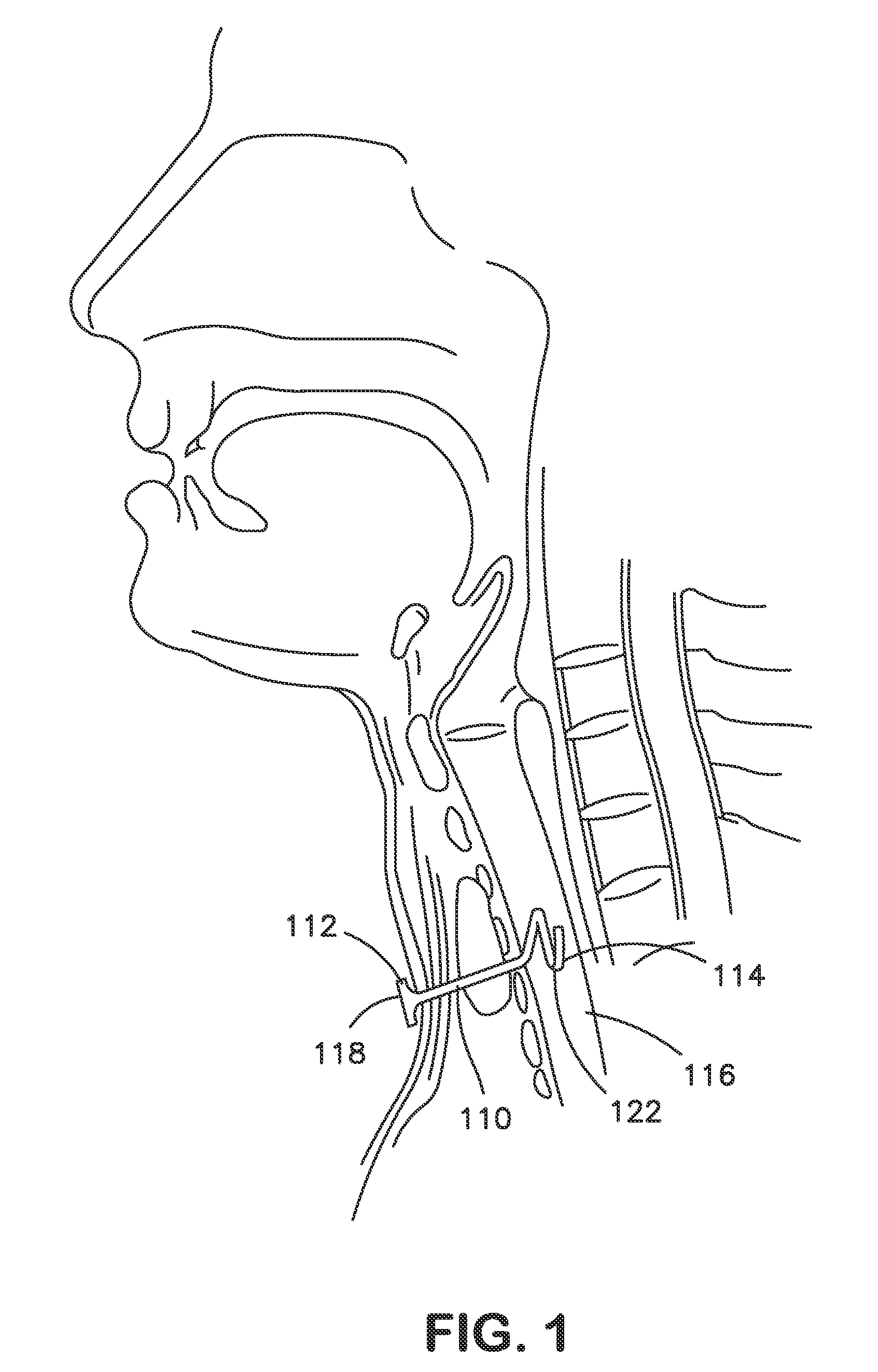 Tracheostomy Appliances and Methods for the Treatment of Sleep Apnea Syndromes