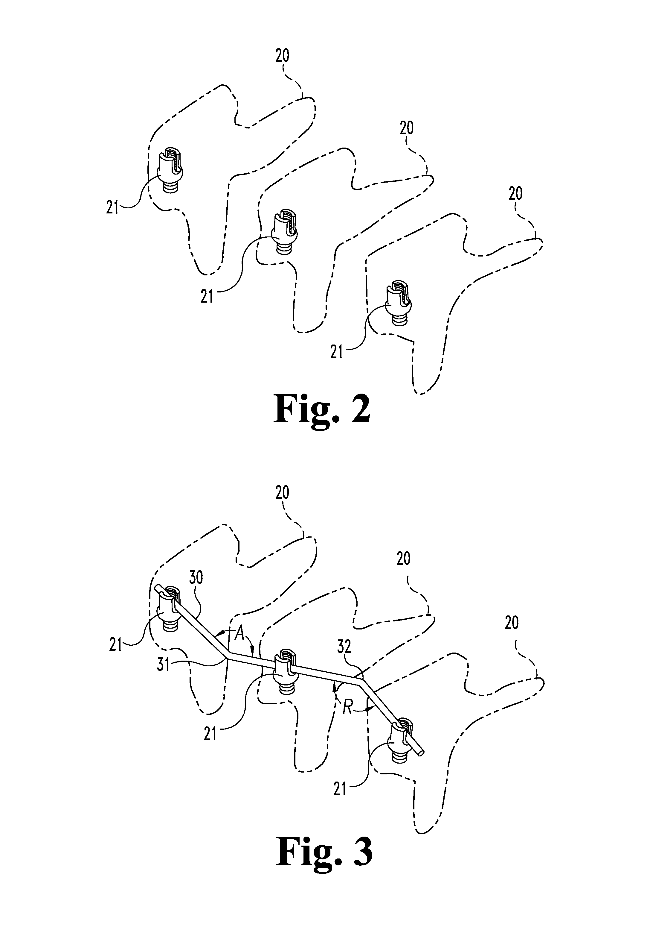 System and device for designing and forming a surgical implant