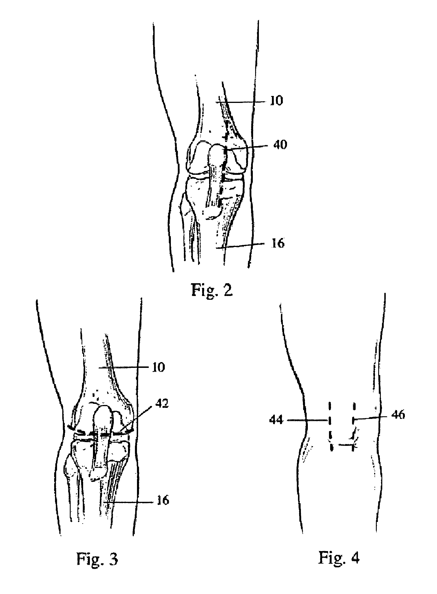 Modular apparatus and method for sculpting the surface of a joint