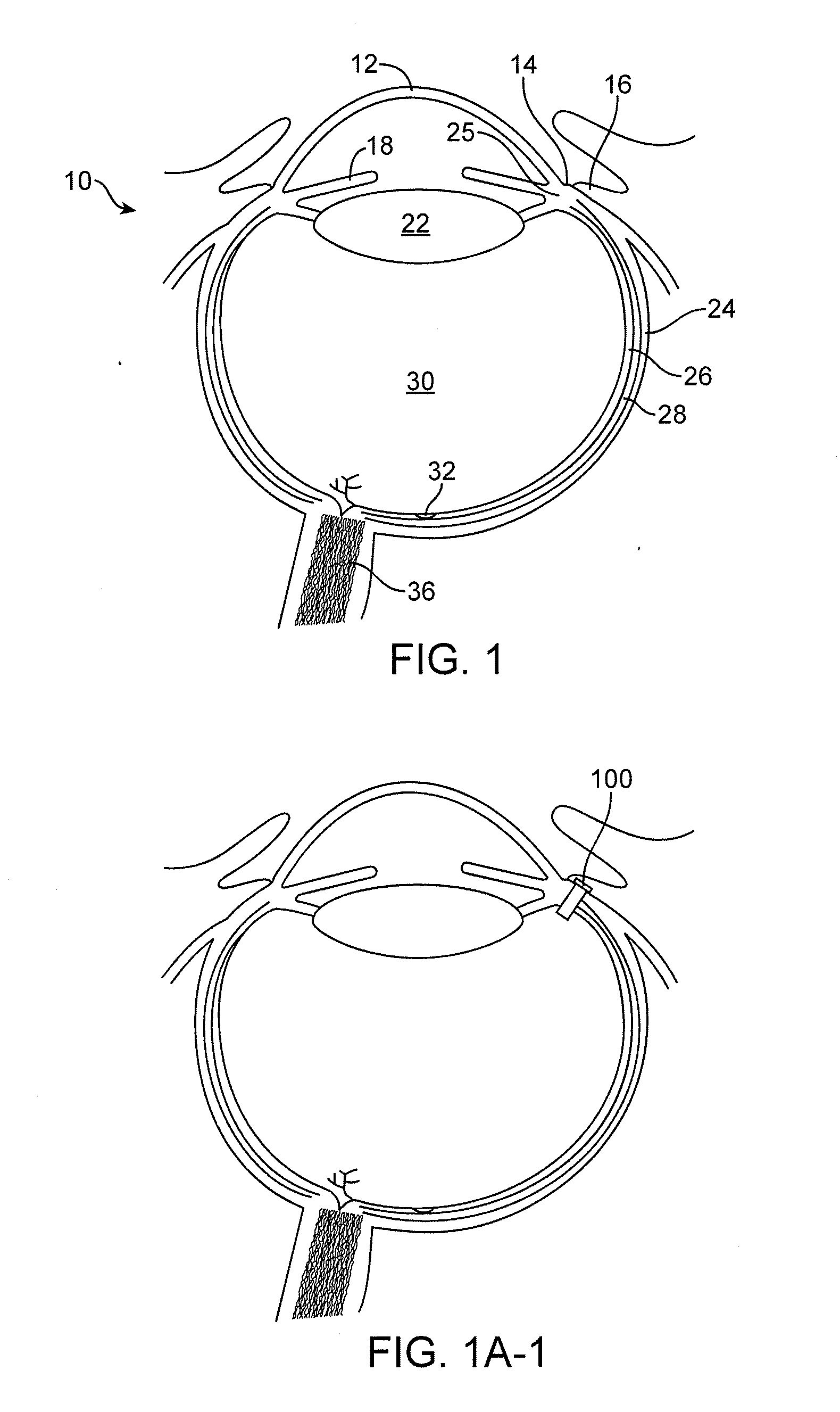 Implantable therapeutic device