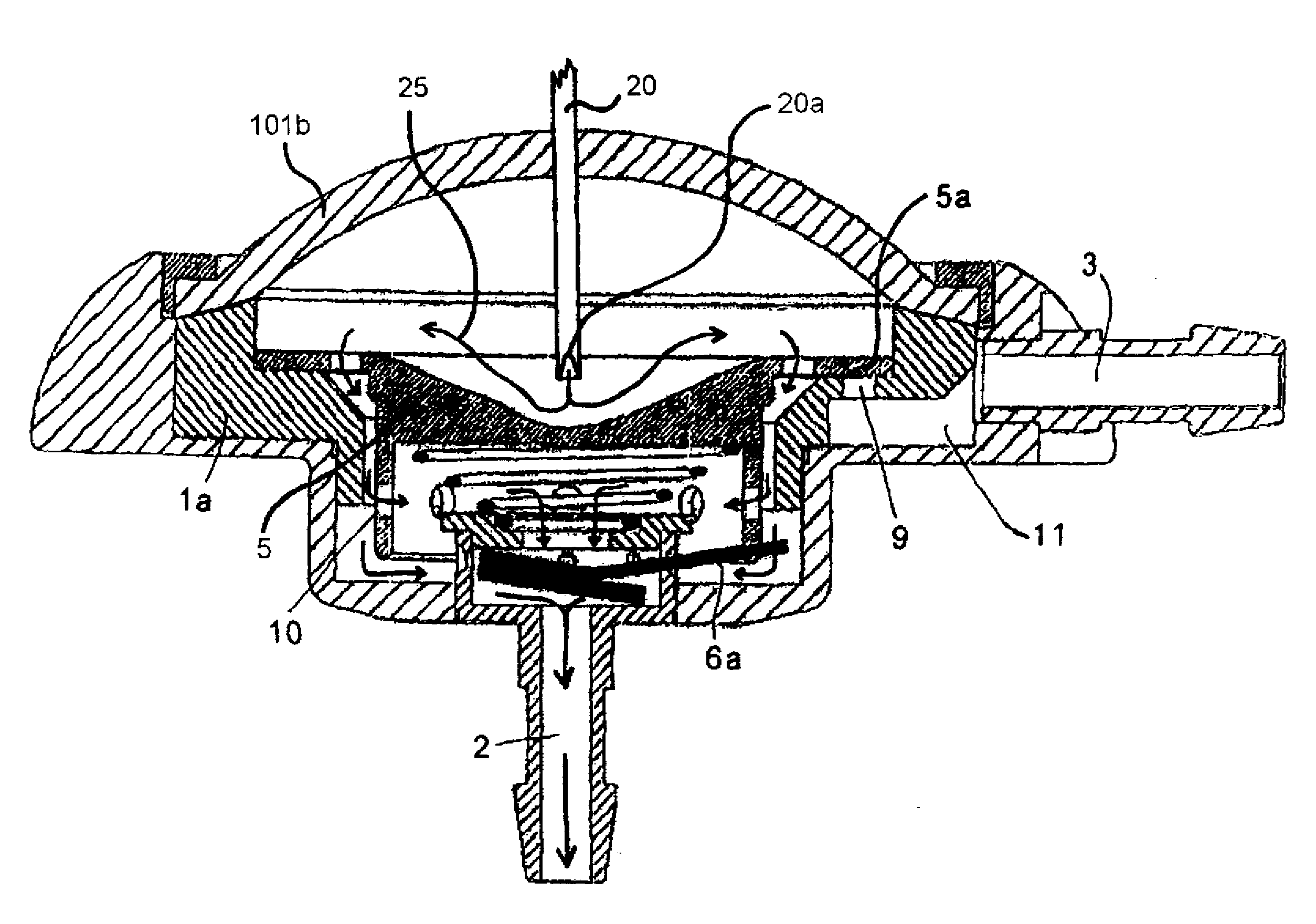 Implantable hydrocephalus shunt system