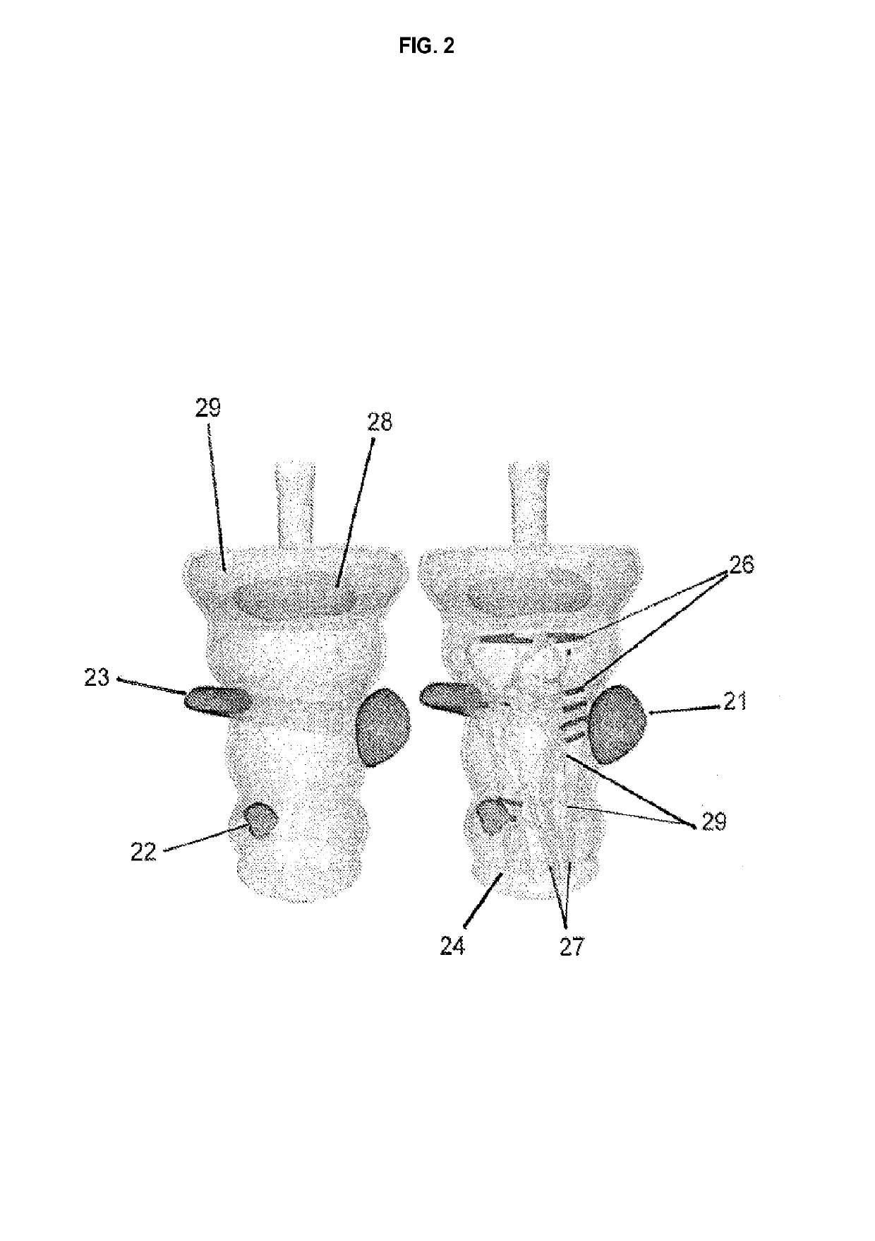 Patient-specific temporary implants for accurately guiding local means of tumor control along patient-specific internal channels to treat cancer