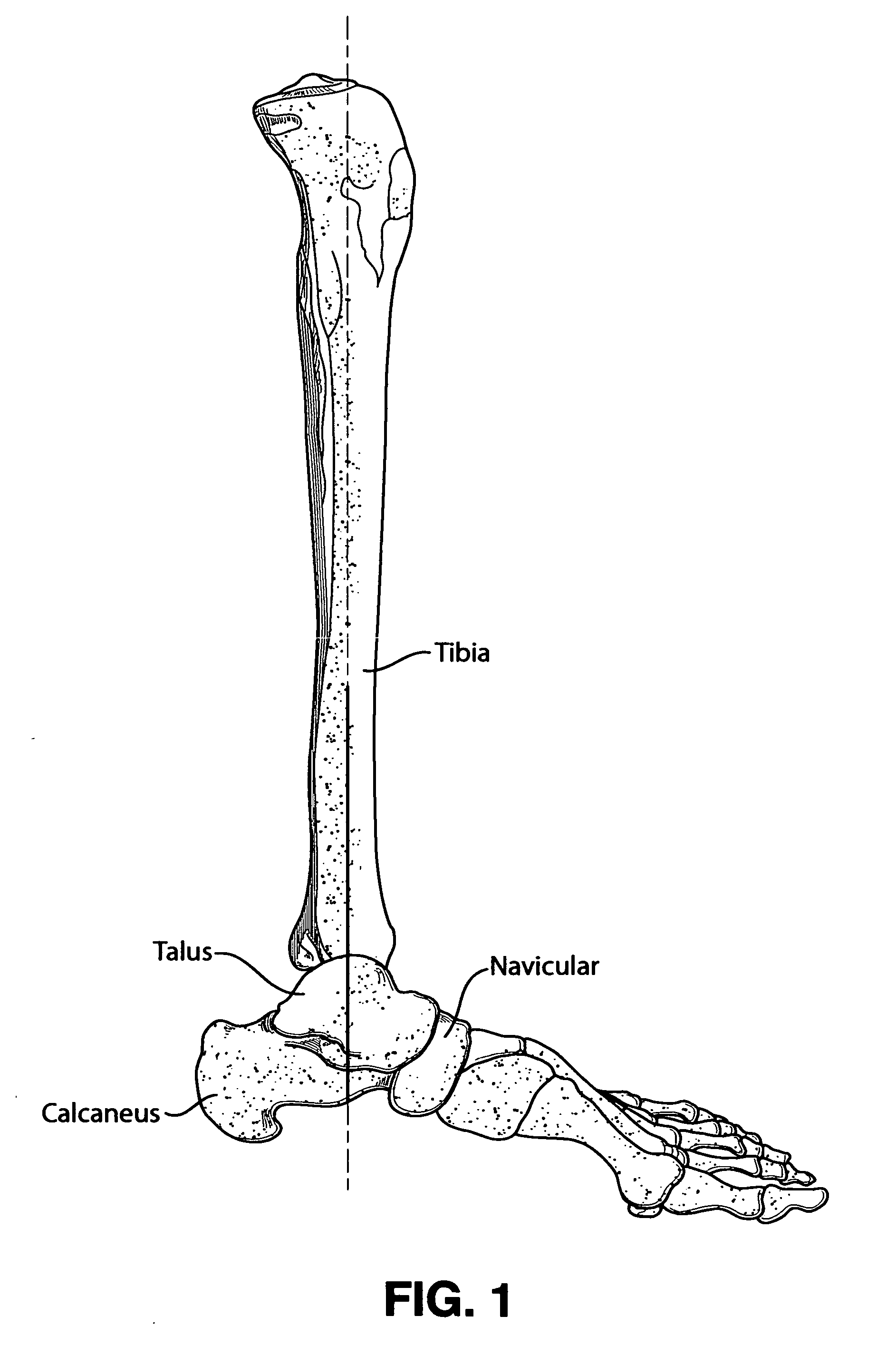 Intramedullary locked compression screw for stabilization and union of complex ankle and subtalar deformities