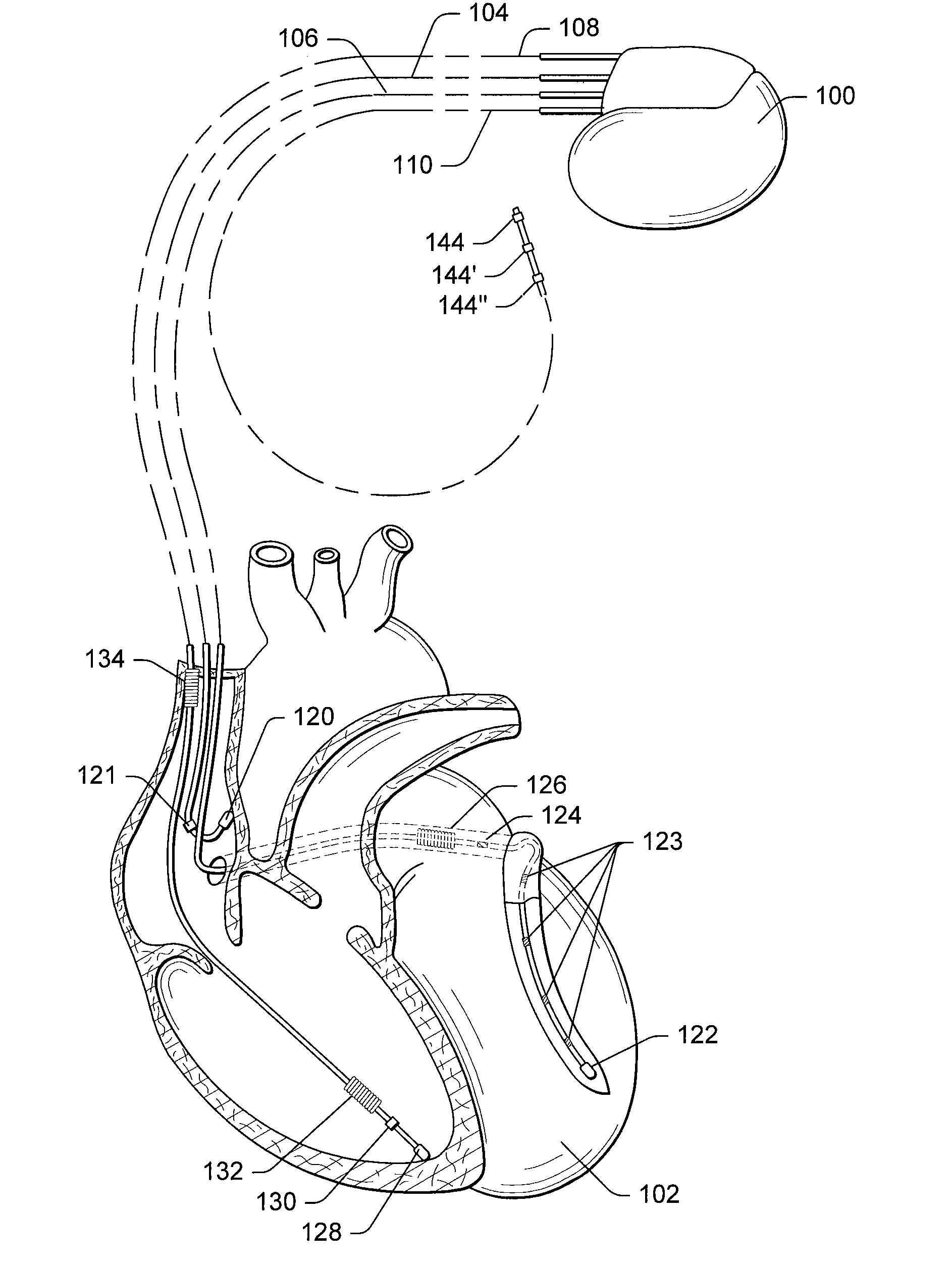 Monitoring hf exacerbation and cardiac resynchronization therapy performance