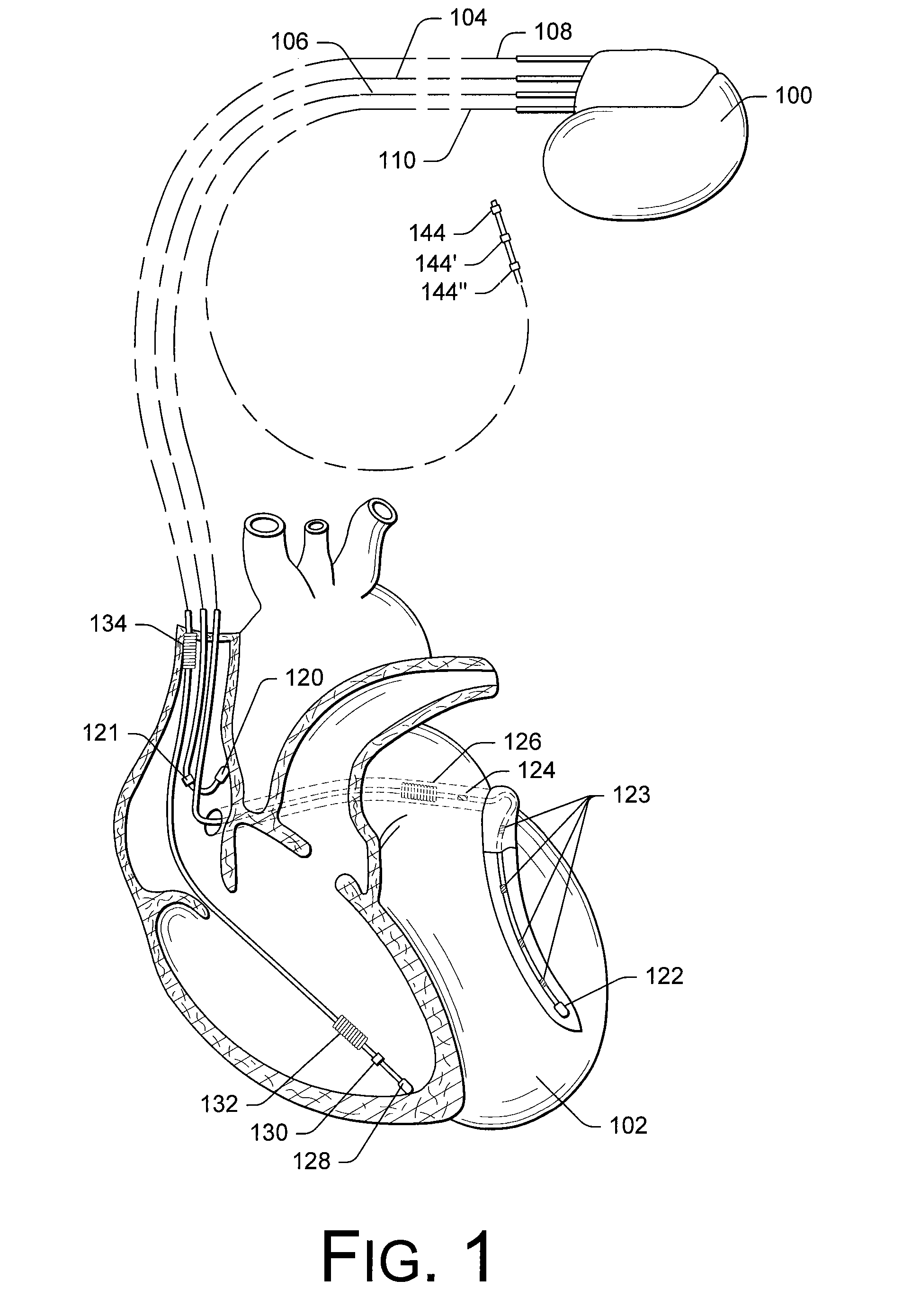 Monitoring hf exacerbation and cardiac resynchronization therapy performance