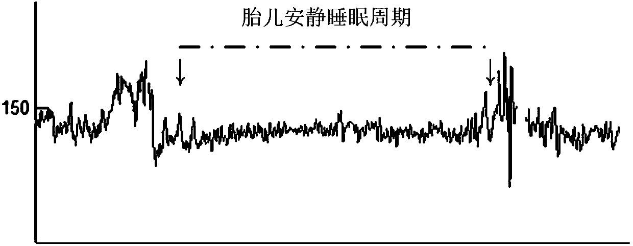 Fetal quiet sleep cycle extraction method based on fetal heart rate curve