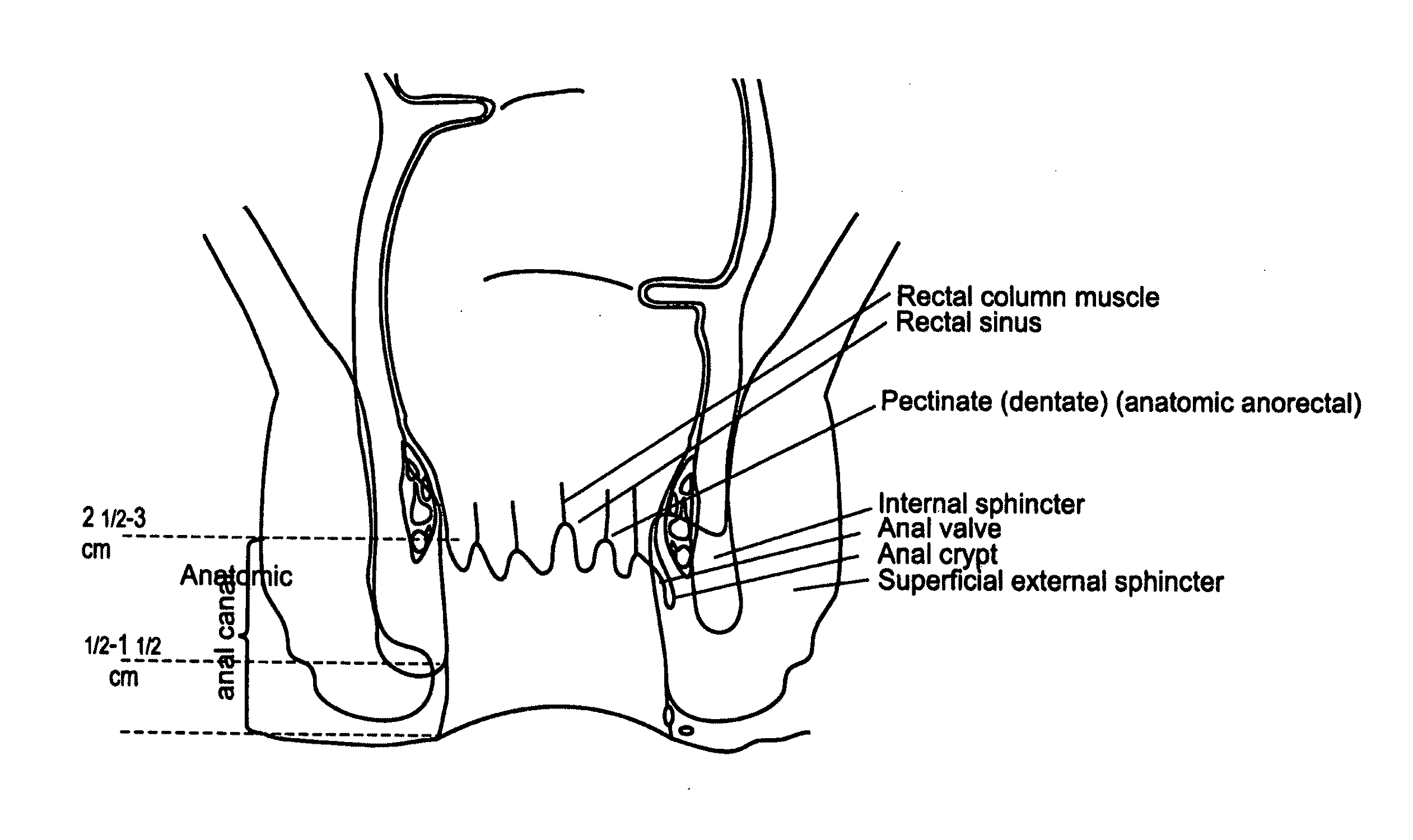 Fecal incontinence device, system and method