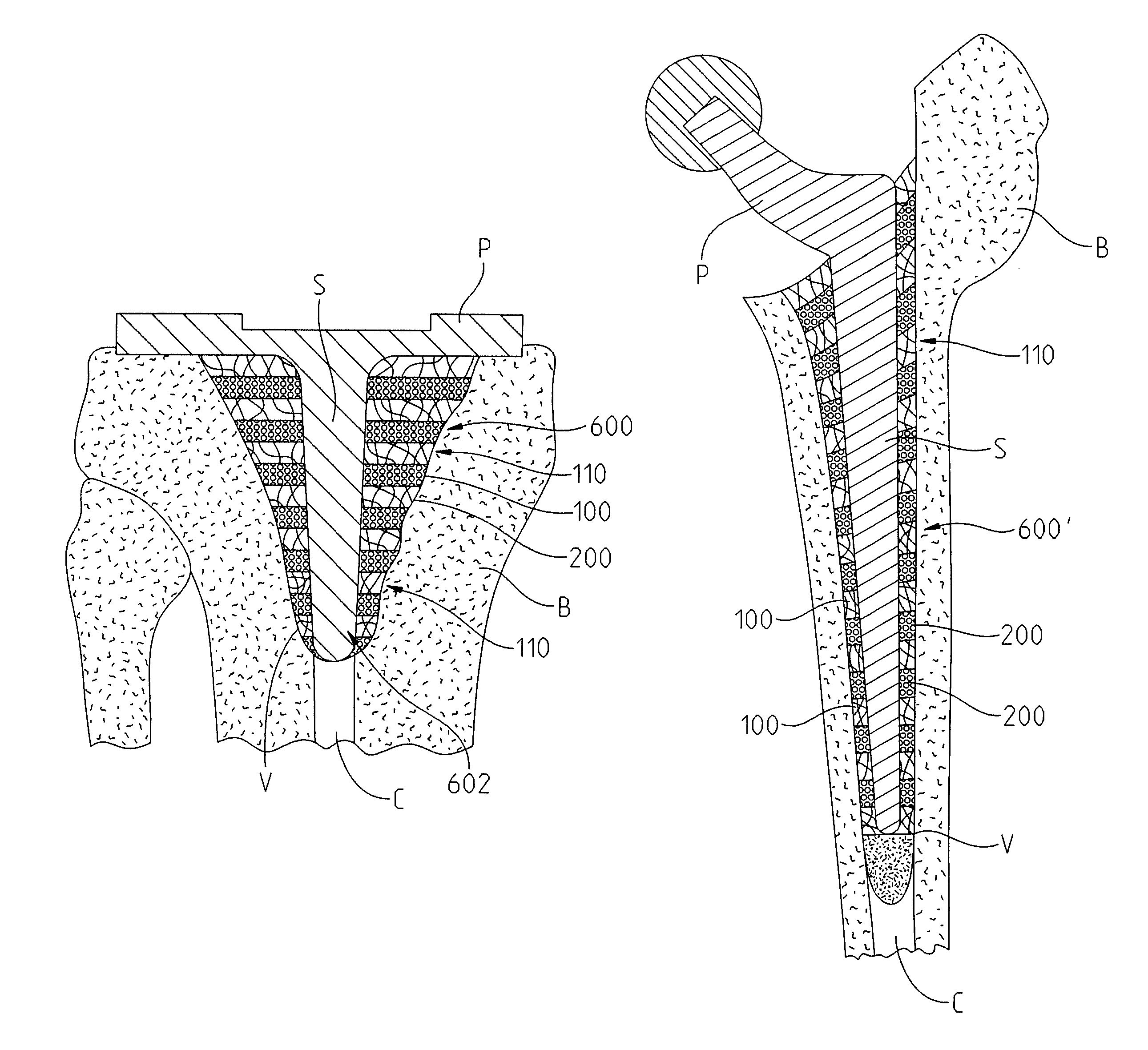 Composite device that combines porous metal and bone stimuli