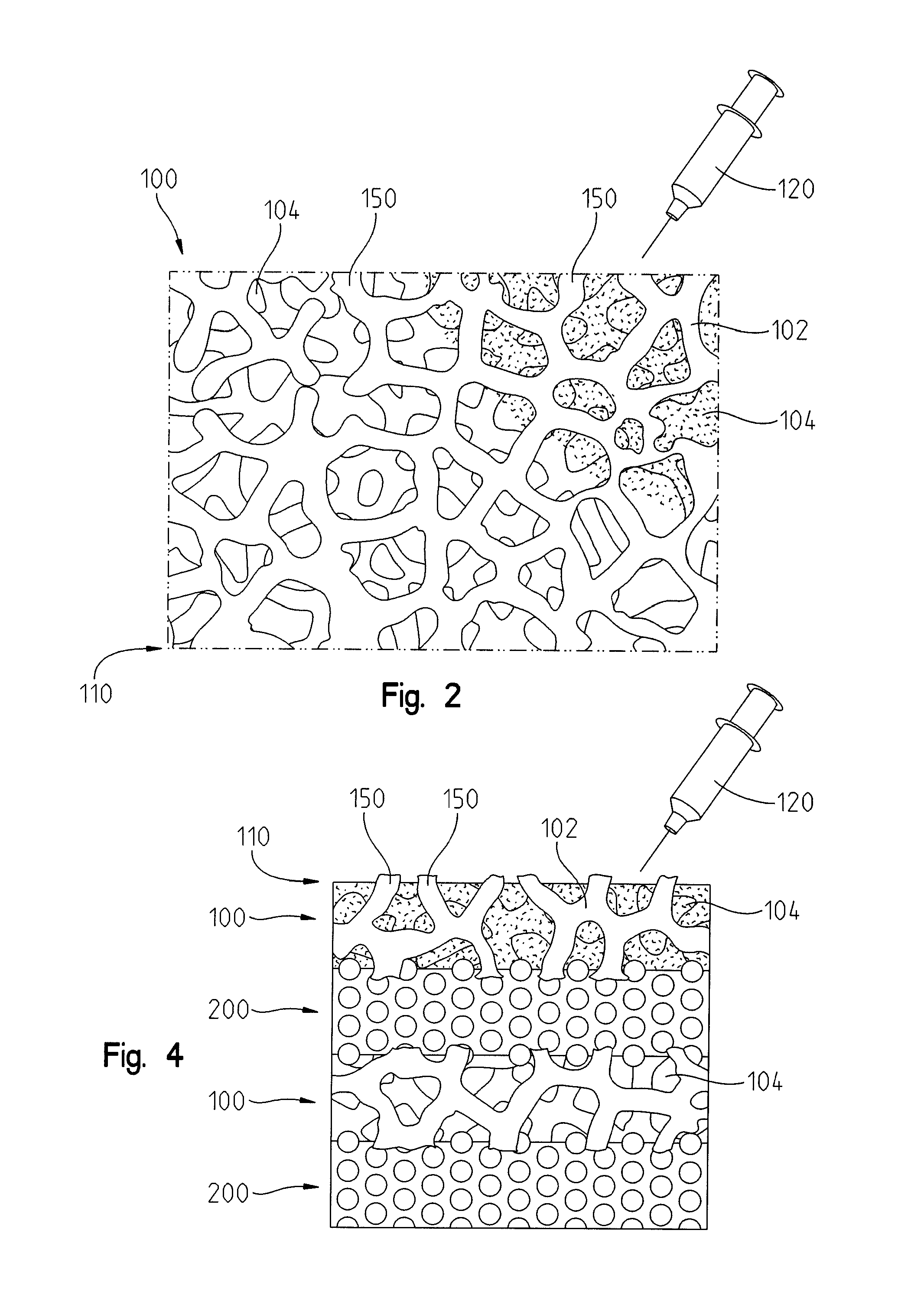 Composite device that combines porous metal and bone stimuli