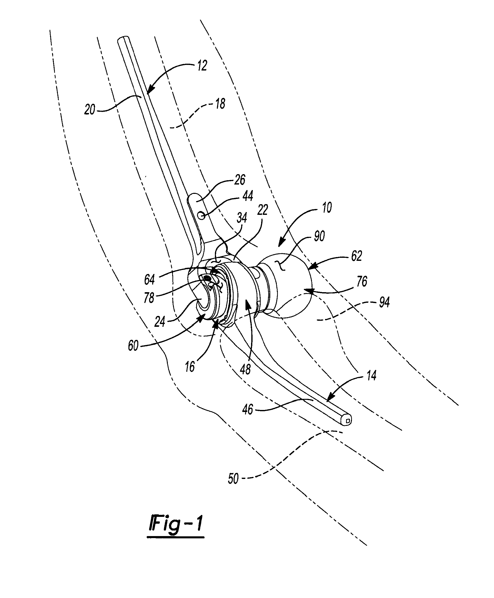 Adjustable lateral articulating condyle