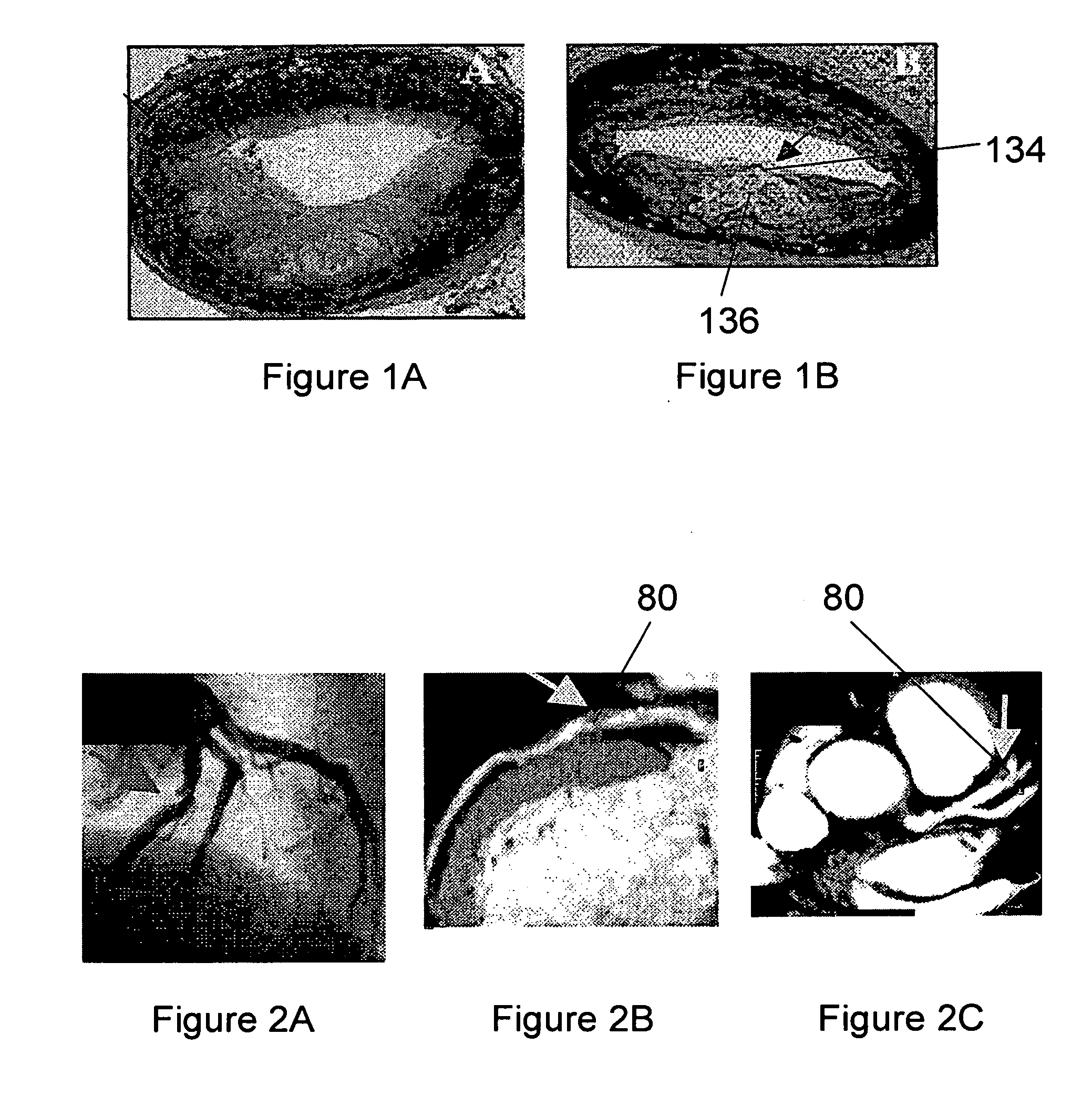 Biomarkers of vulnerable atherosclerotic plaques and methods of use