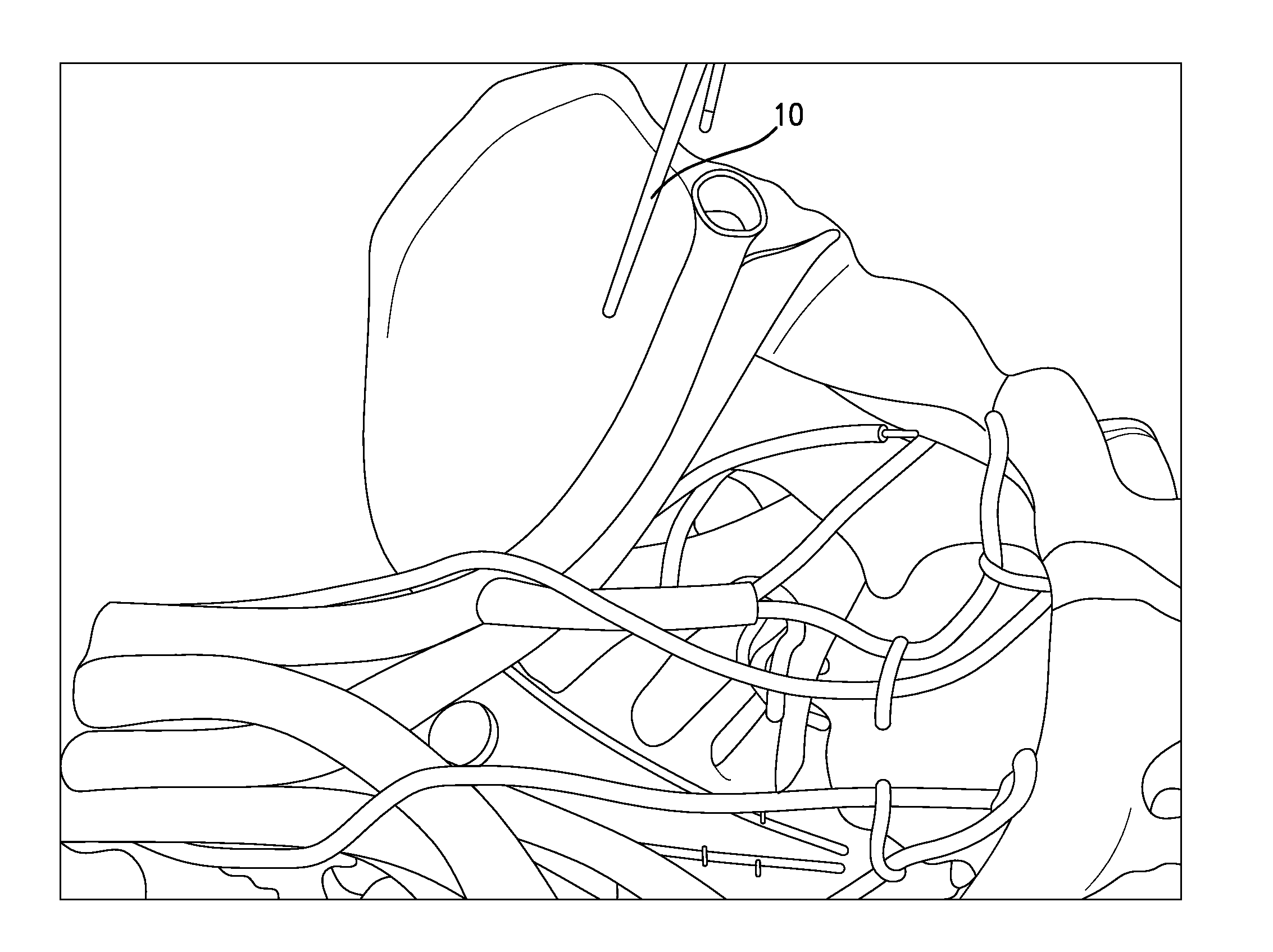 System and method for implantation of lead and electrodes to the endopelvic portion of the pelvic nerves to treat pelvic floor/organ dysfunctions and pelvic neuropathic pain