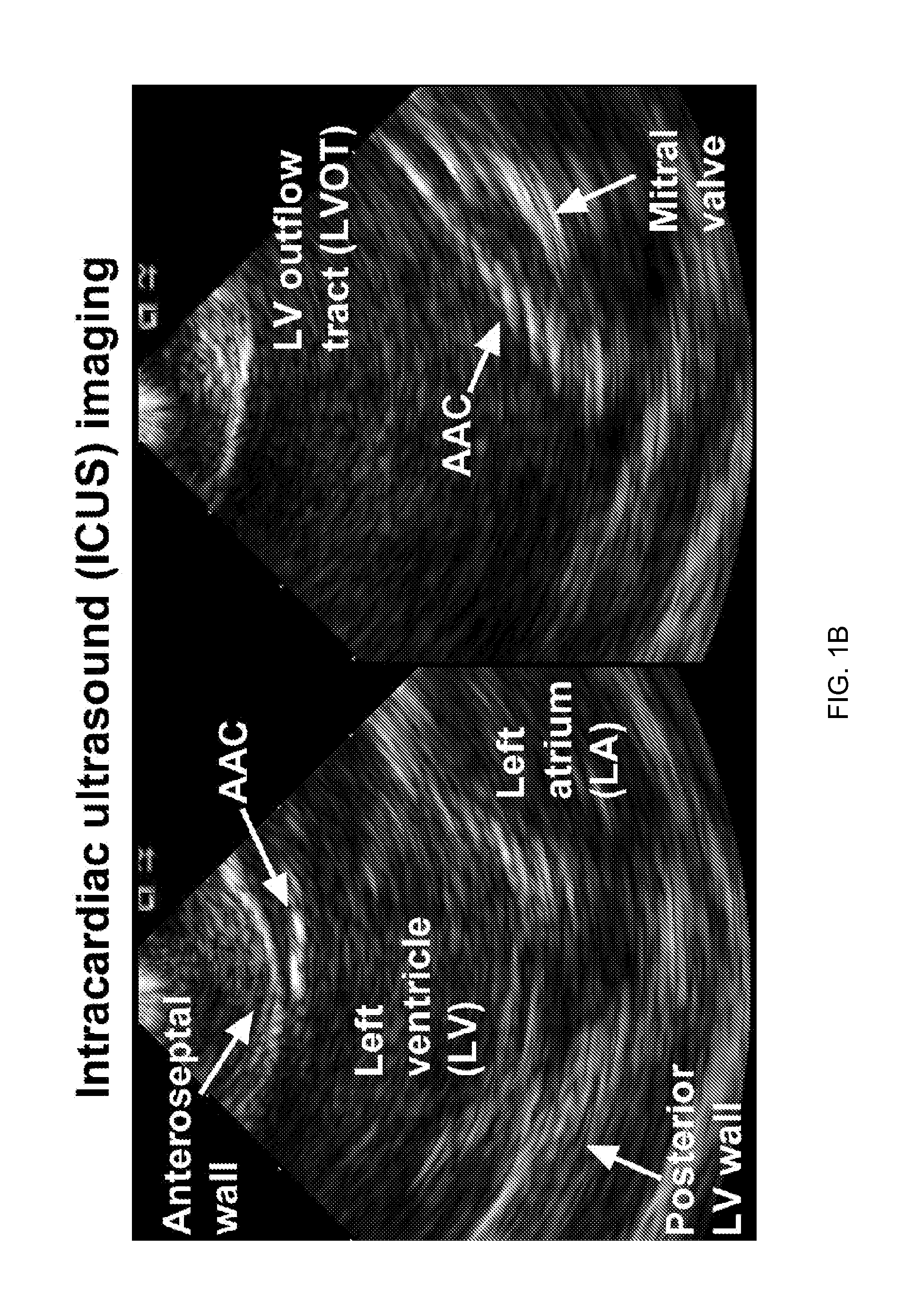 Steerable catheter navigation with the use of interference ultrasonography