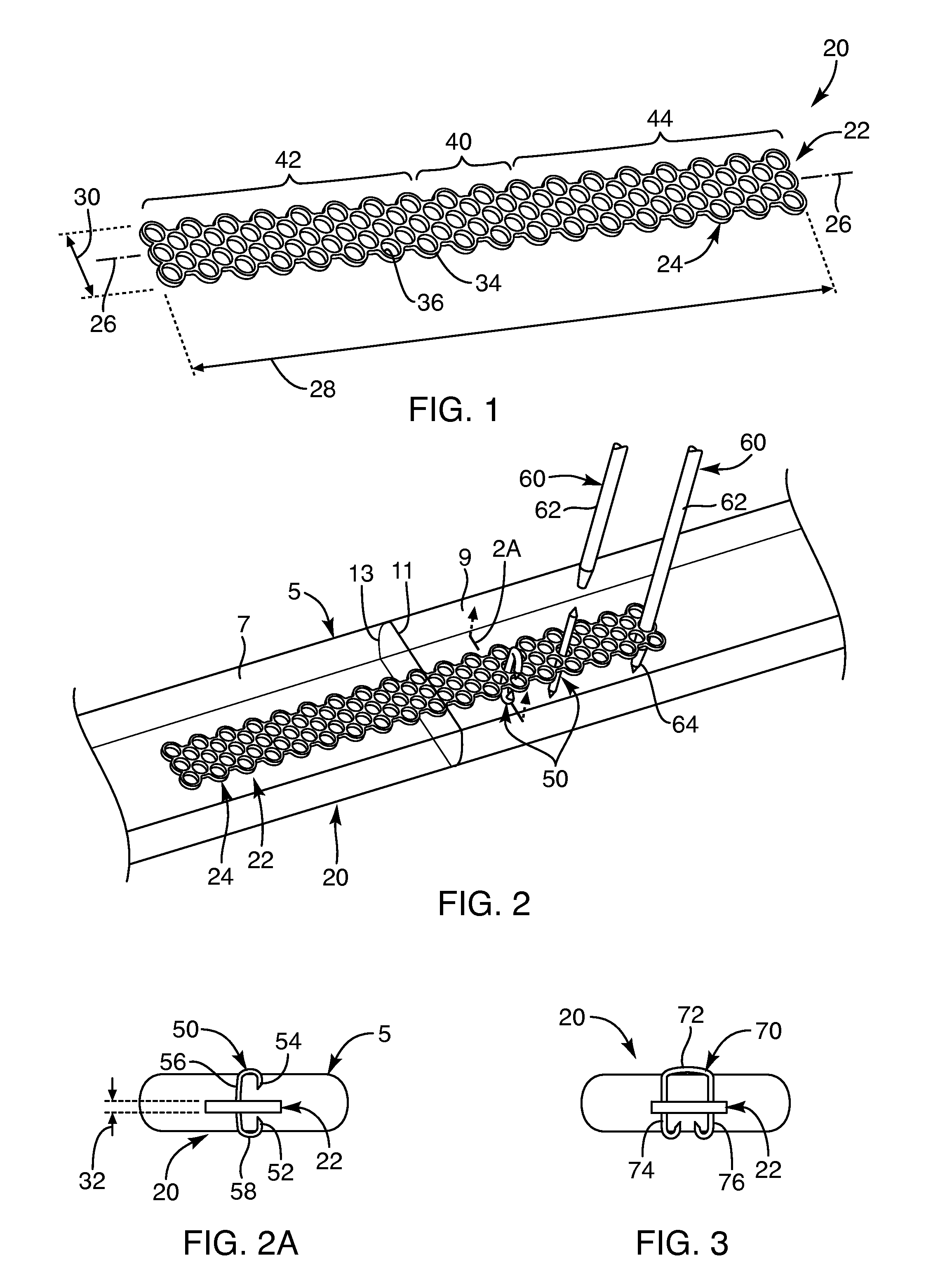 Soft tissue repair devices, systems, and methods