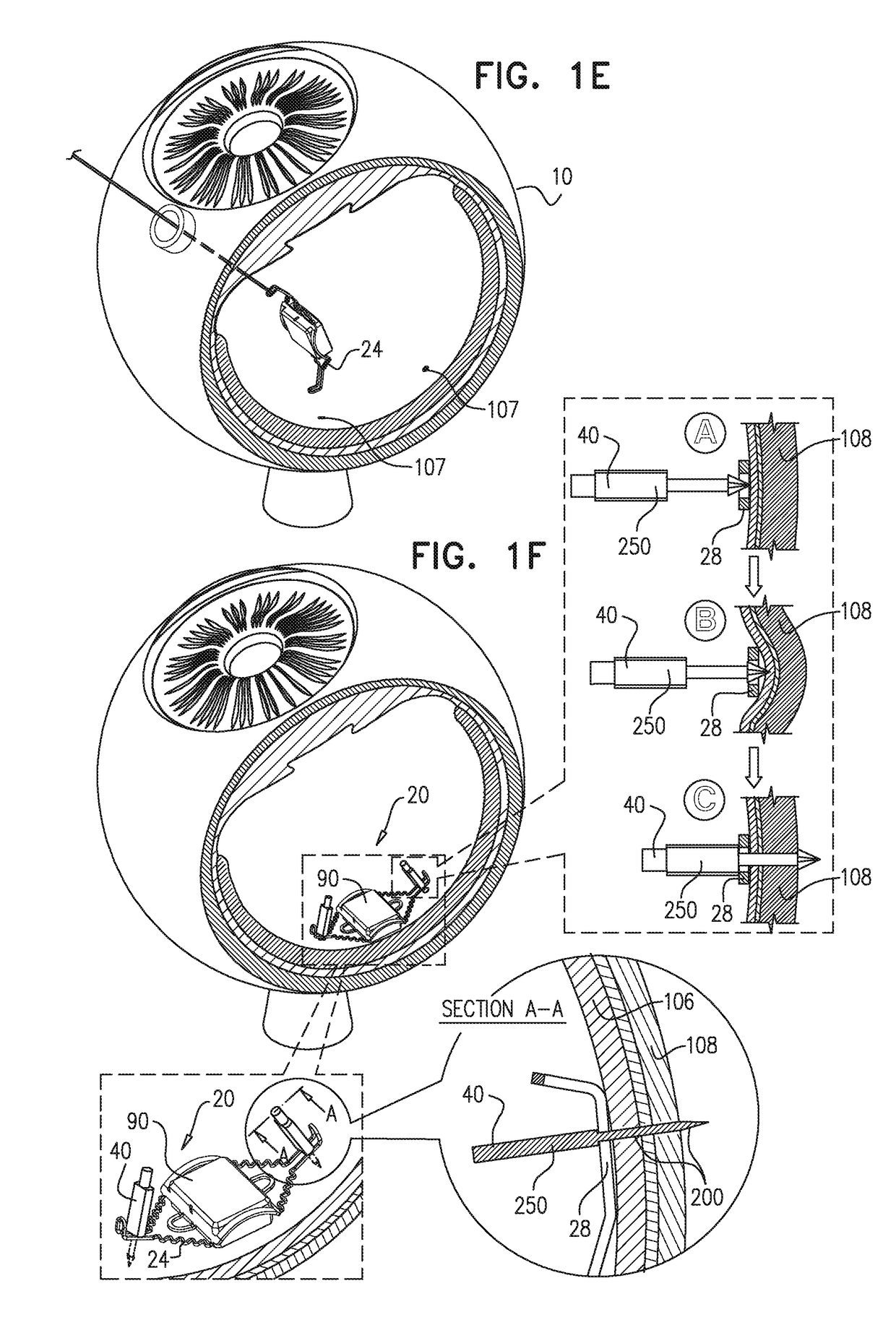 Retinal implant fixation