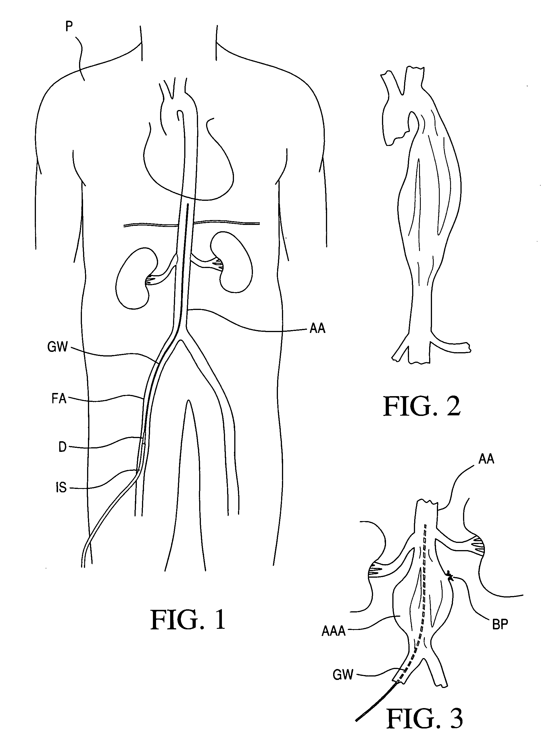 Vascular dilator for controlling blood flow in a blood vessel