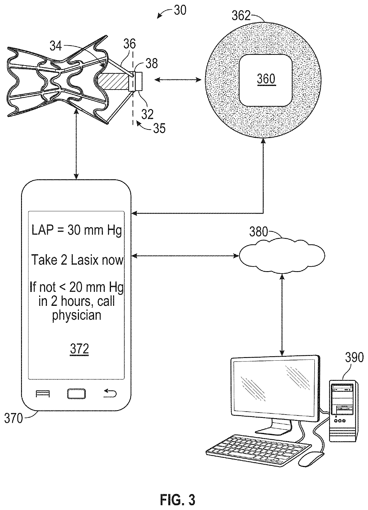 Interatrial shunt having physiologic sensor