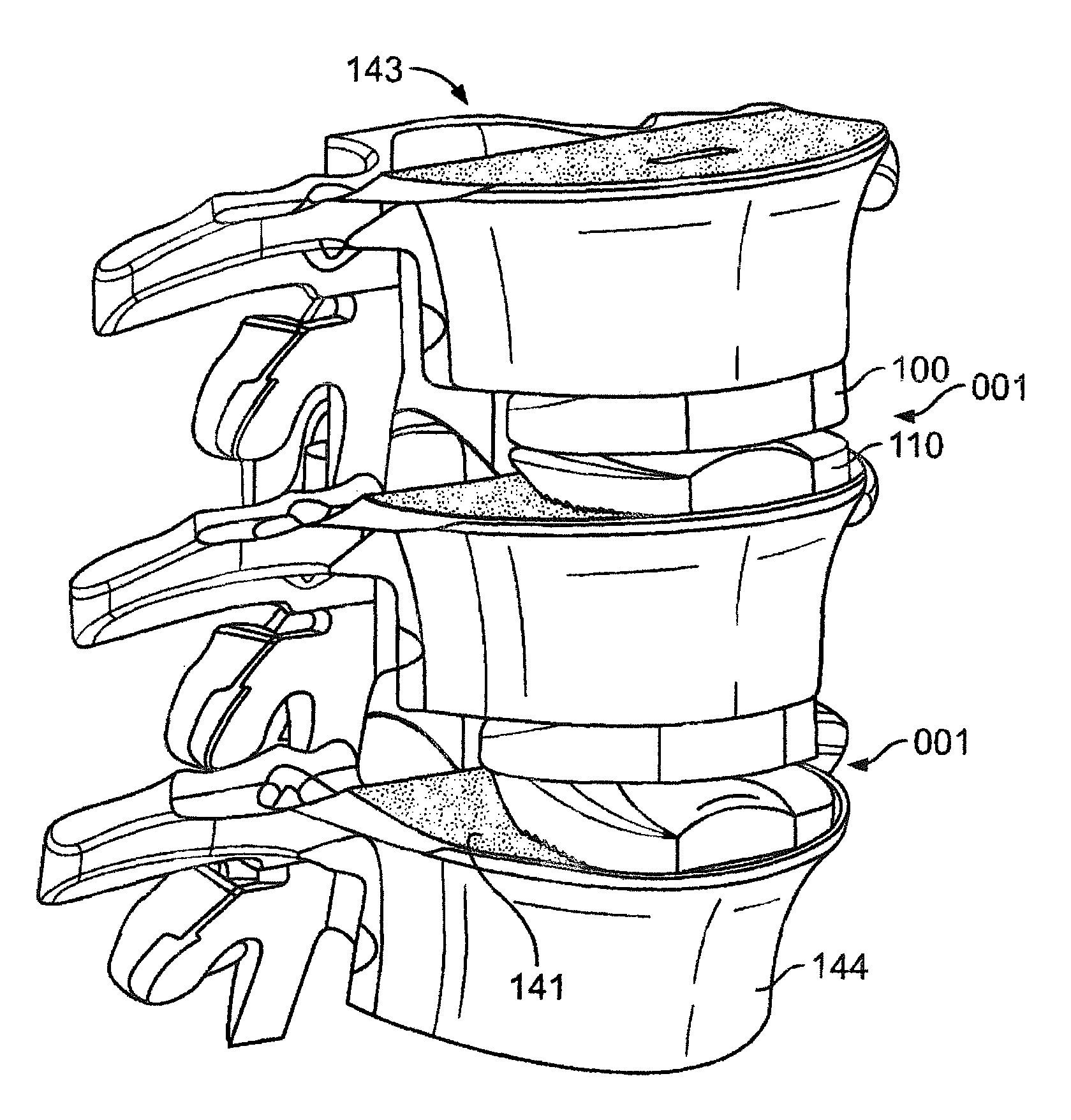 Systems and Apparatuses for Inserting an Implant in Intervertebral Space