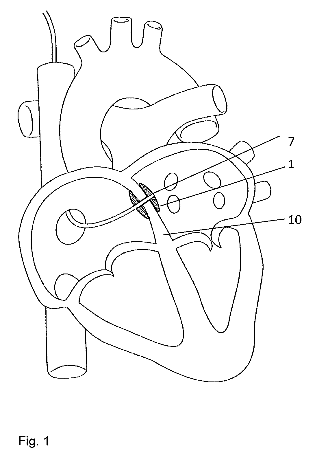 Implantable indifferent reference electrode pole