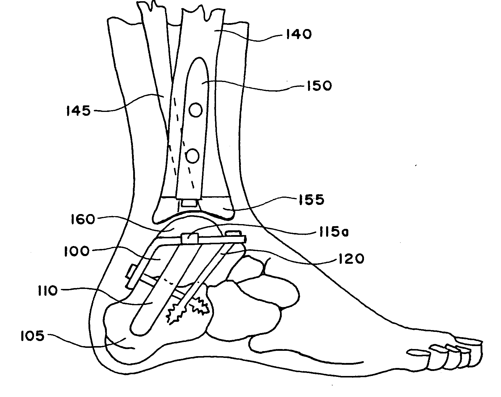 Ankle replacement system