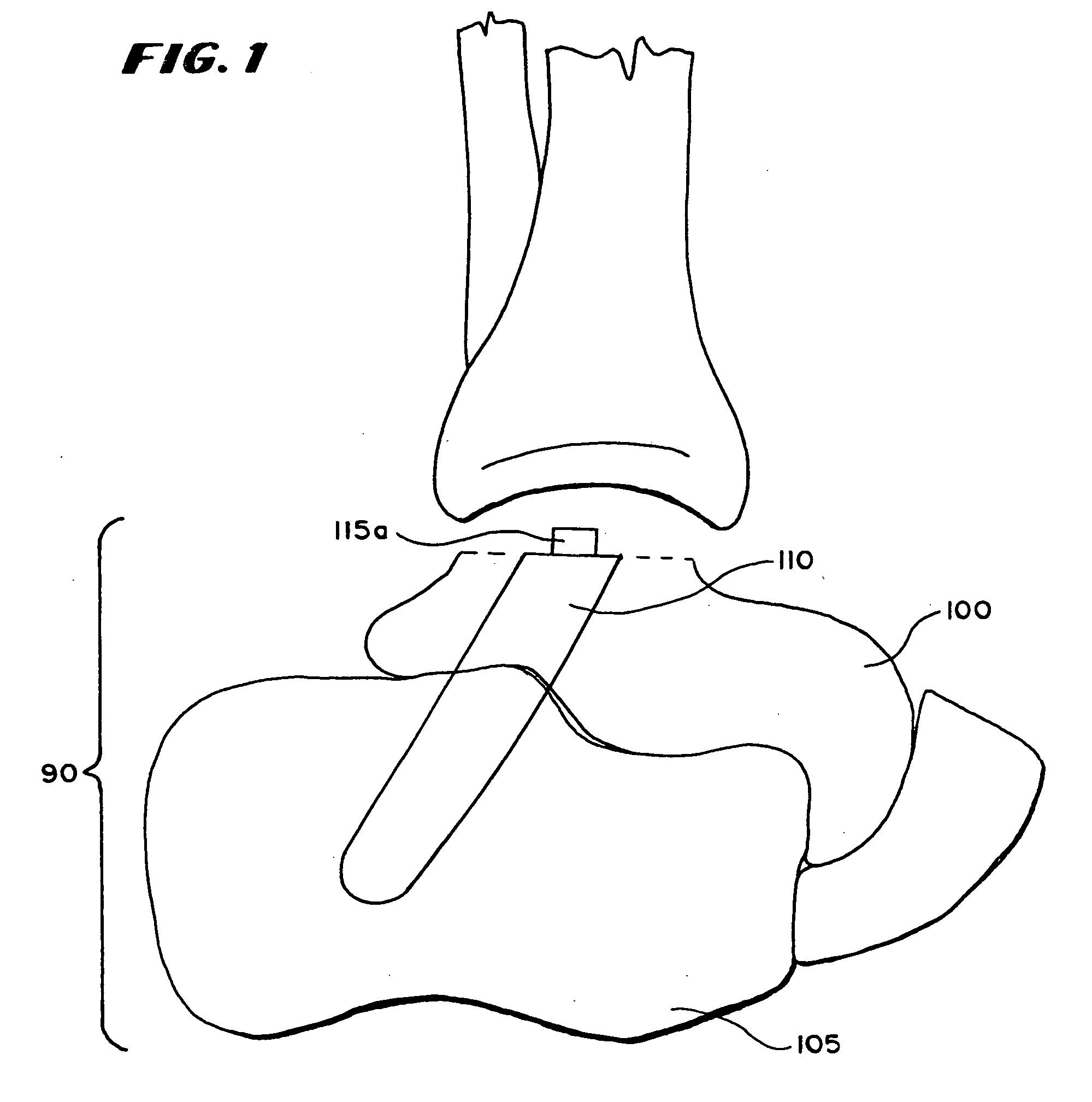 Ankle replacement system