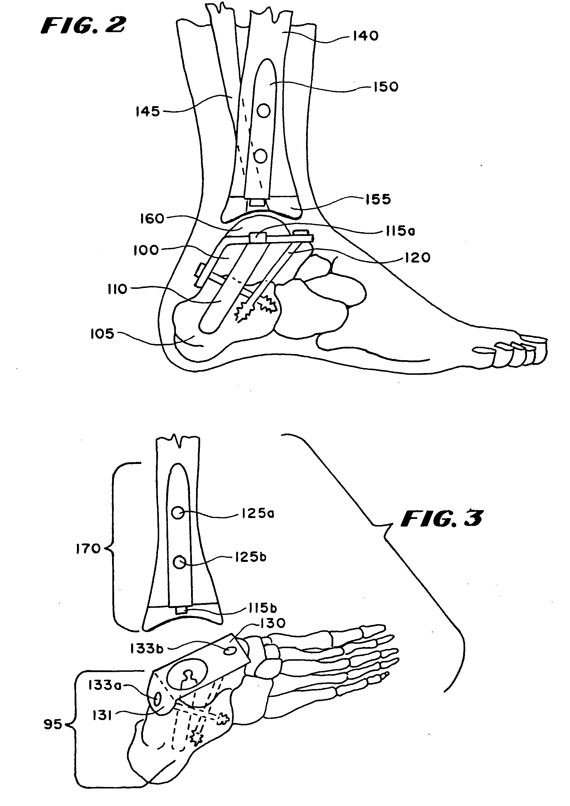 Ankle replacement system