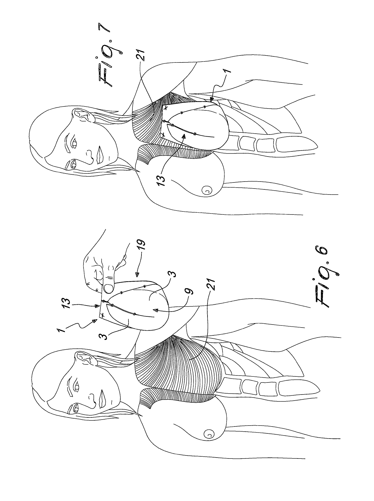 Medical device for breast reconstruction