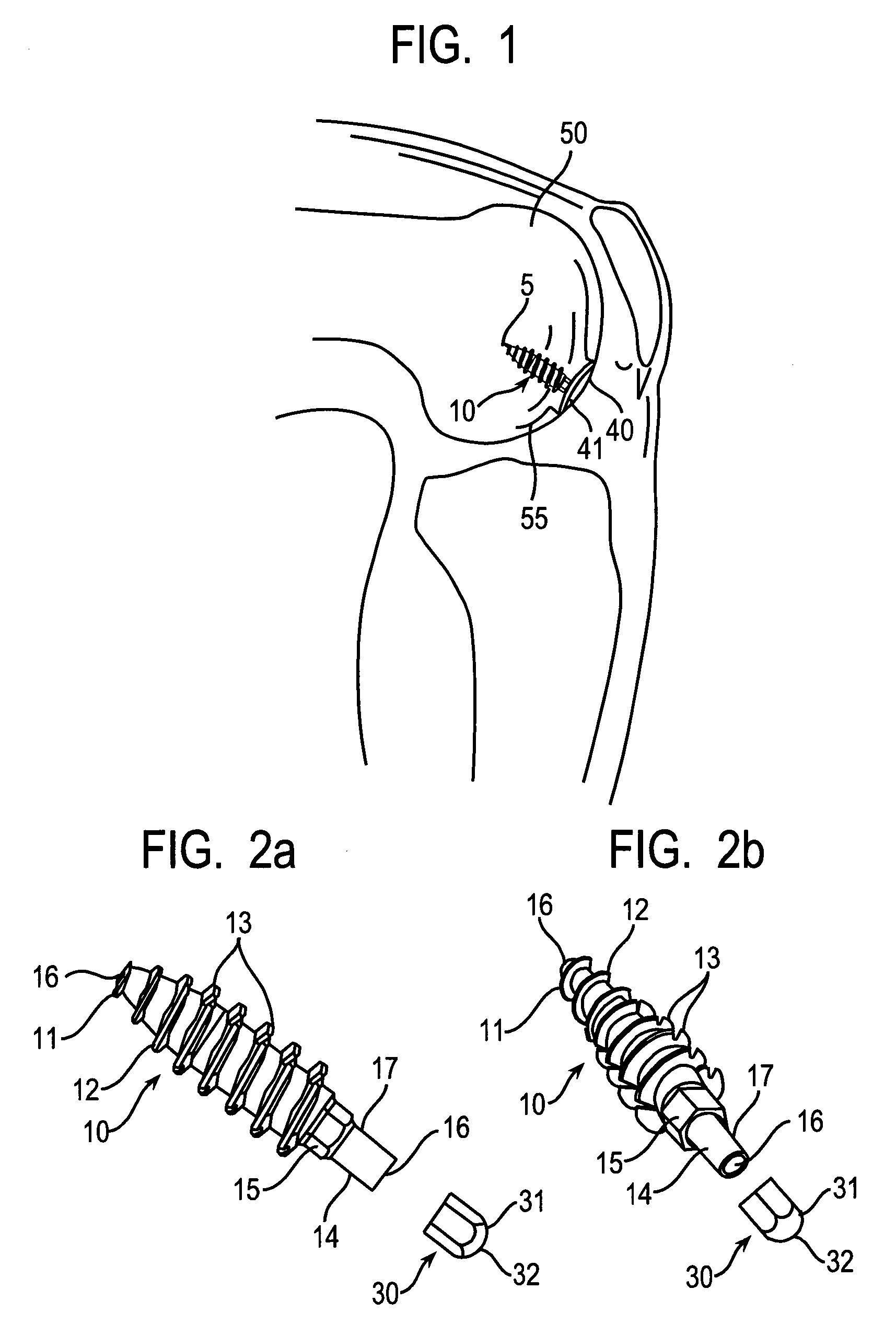 System and method for joint resurface repair