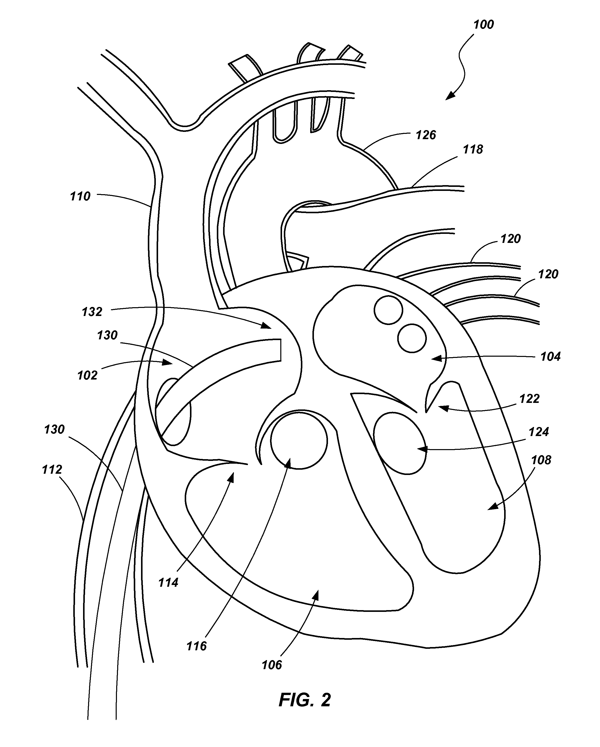 Ventricular assist device and related methods