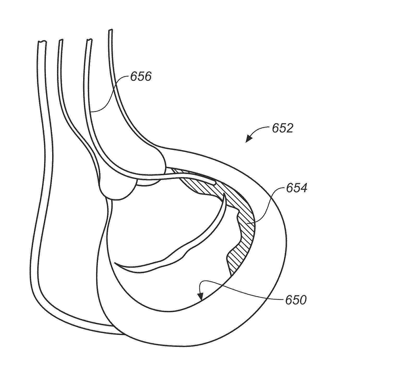 Diagnostic catheters, guide catheters, visualization devices and chord manipulation devices, and related kits and methods