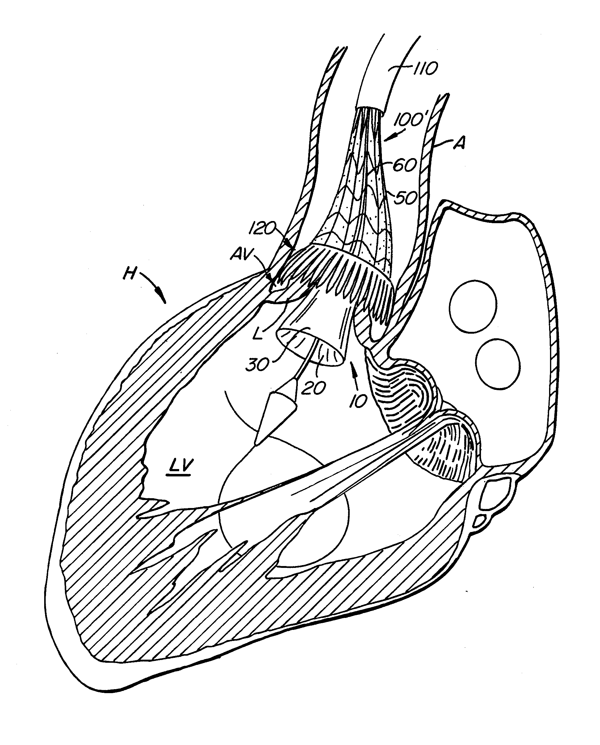 Assessing the location and performance of replacement heart valves