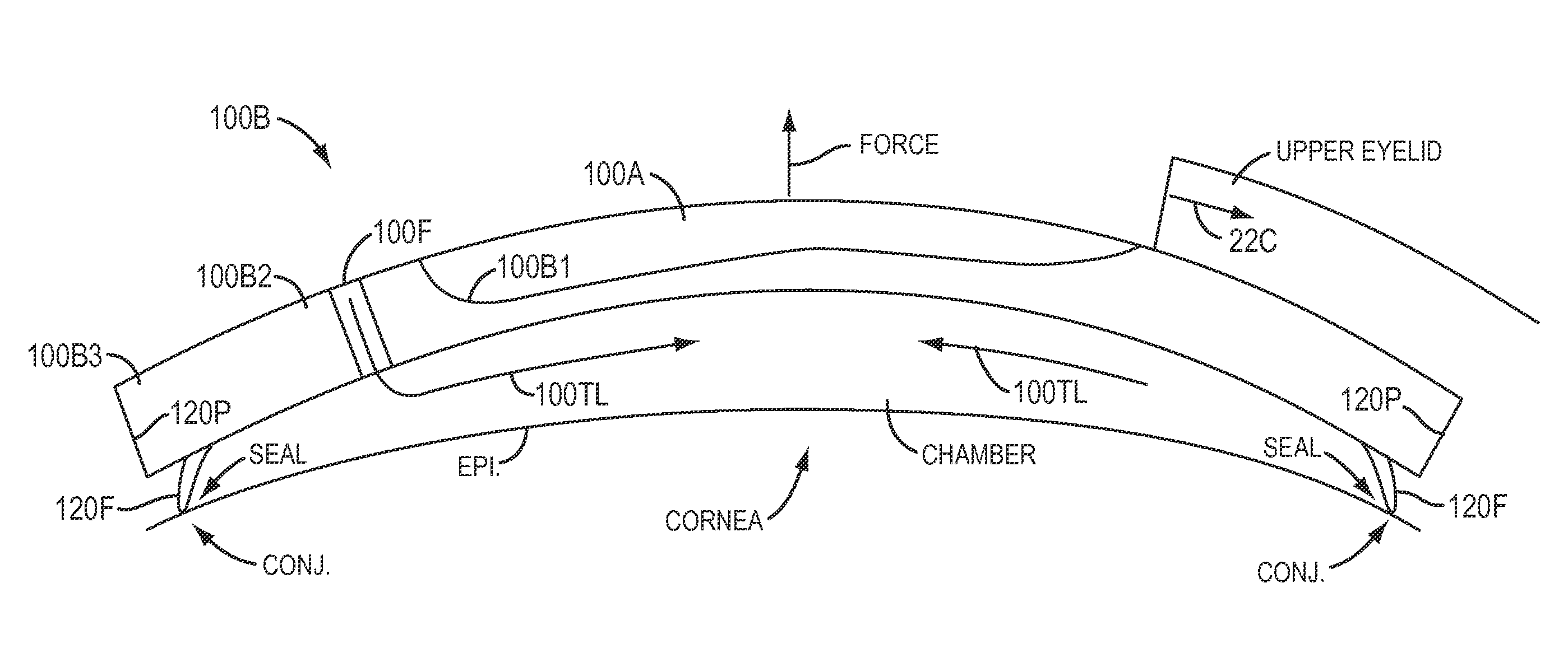 Contact lenses for refractive correction