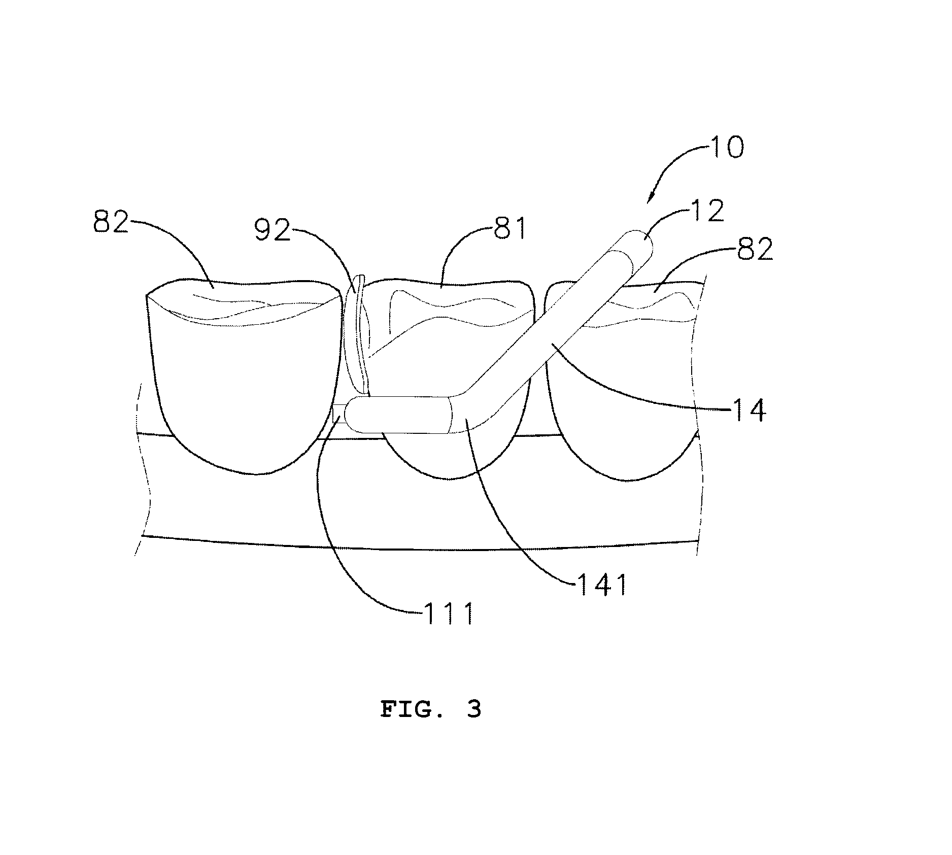 Separating ring