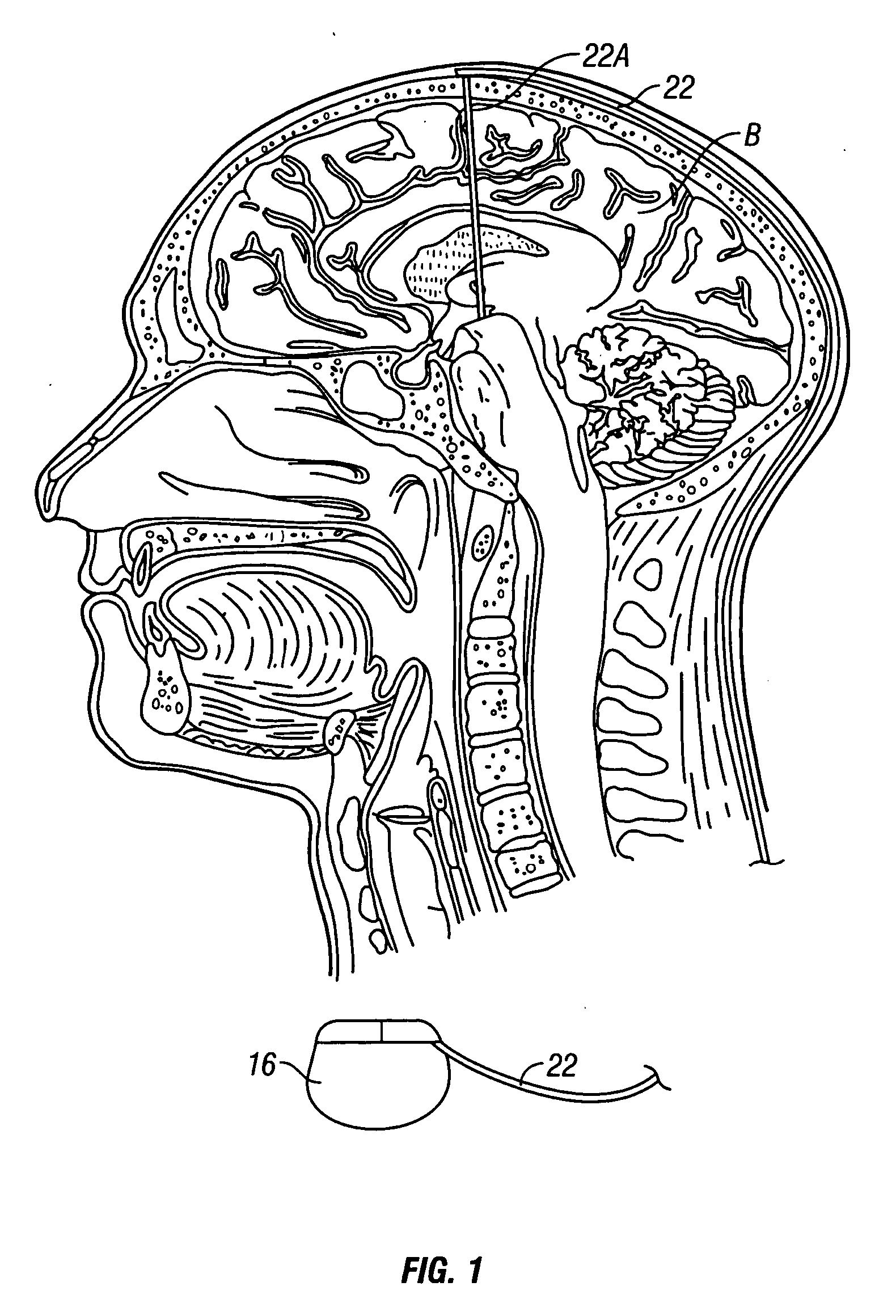 System and method of treating stuttering by neuromodulation