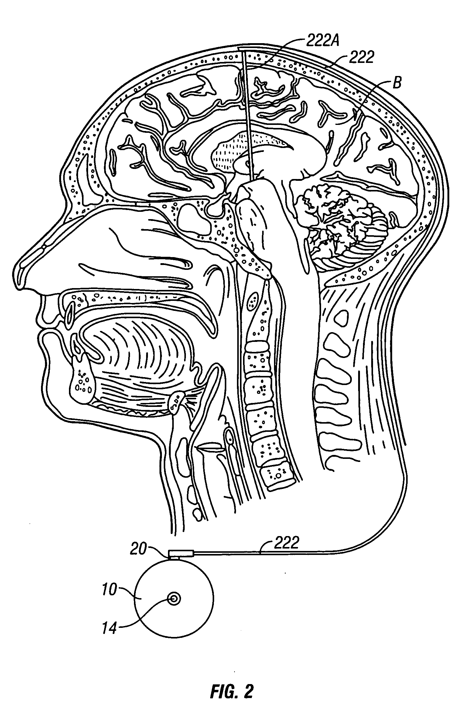 System and method of treating stuttering by neuromodulation