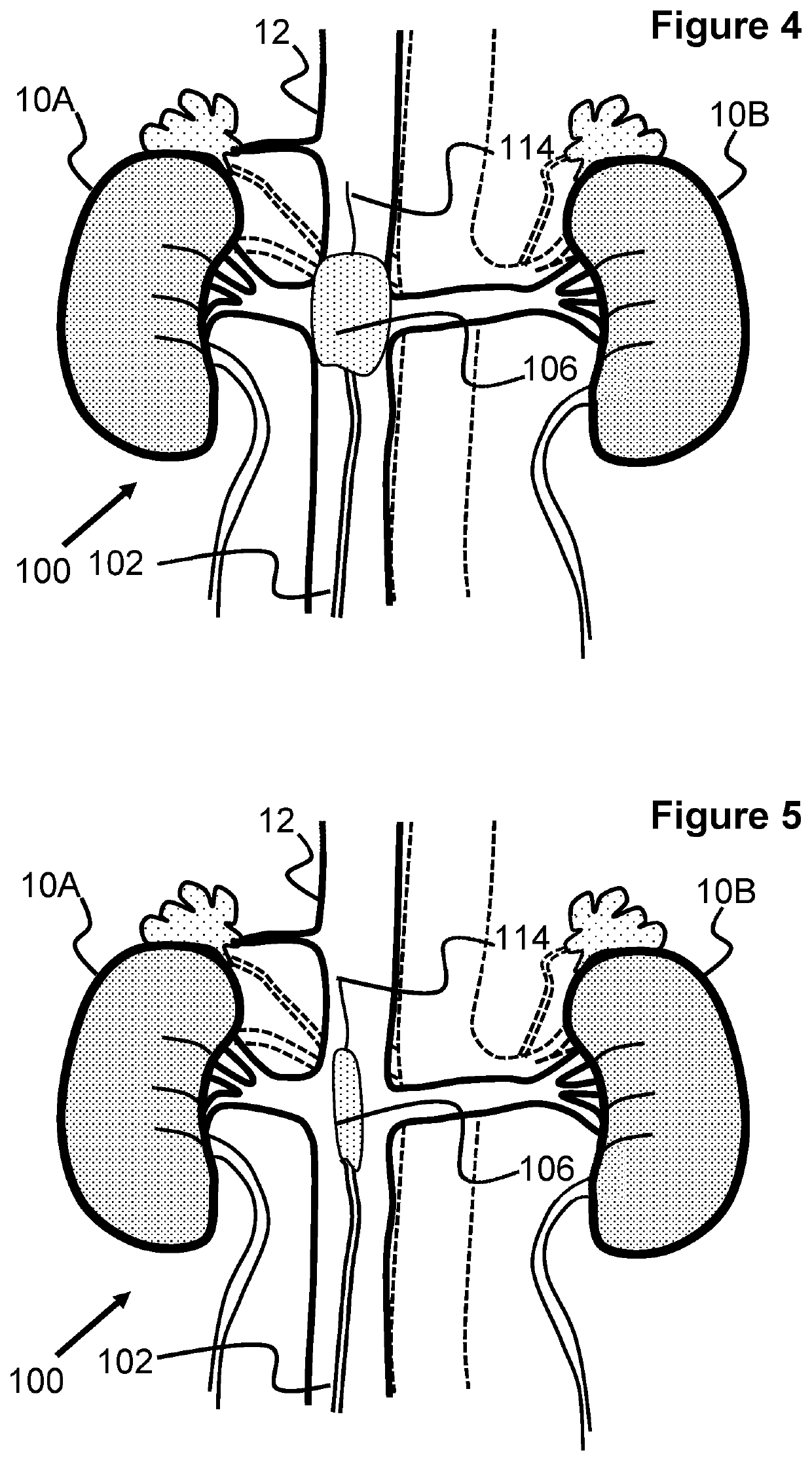 Blood Pump Or Balloon Cycling And Venous Occlusion