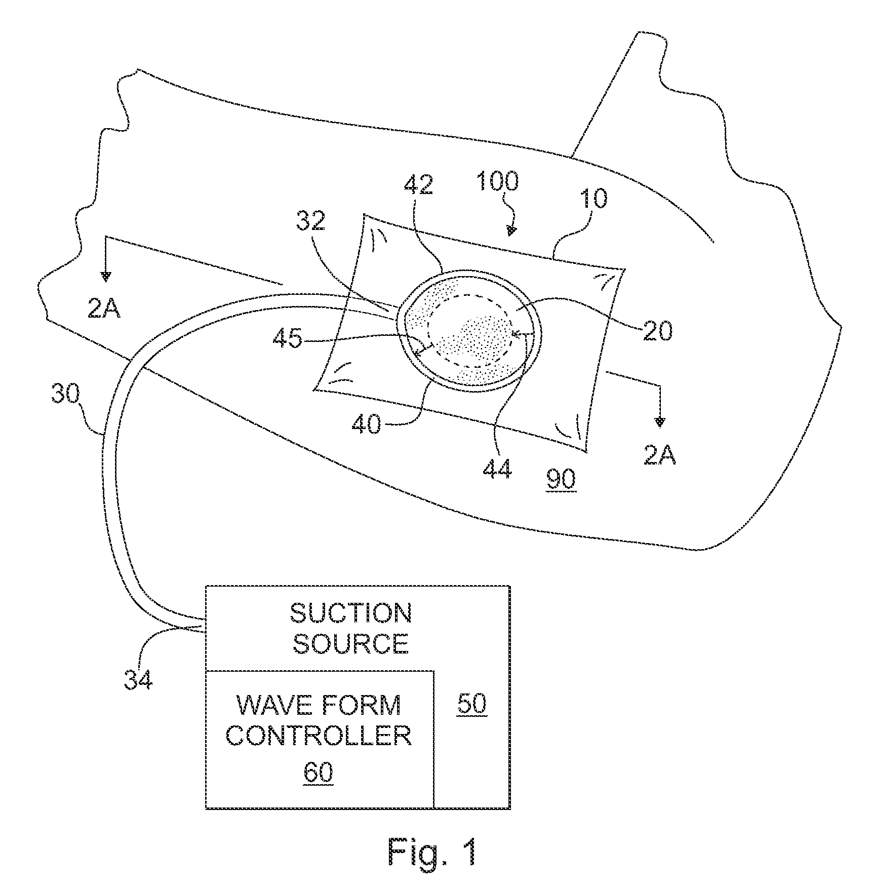 Apparatus and method for wound treatment employing periodic sub-atmospheric pressure