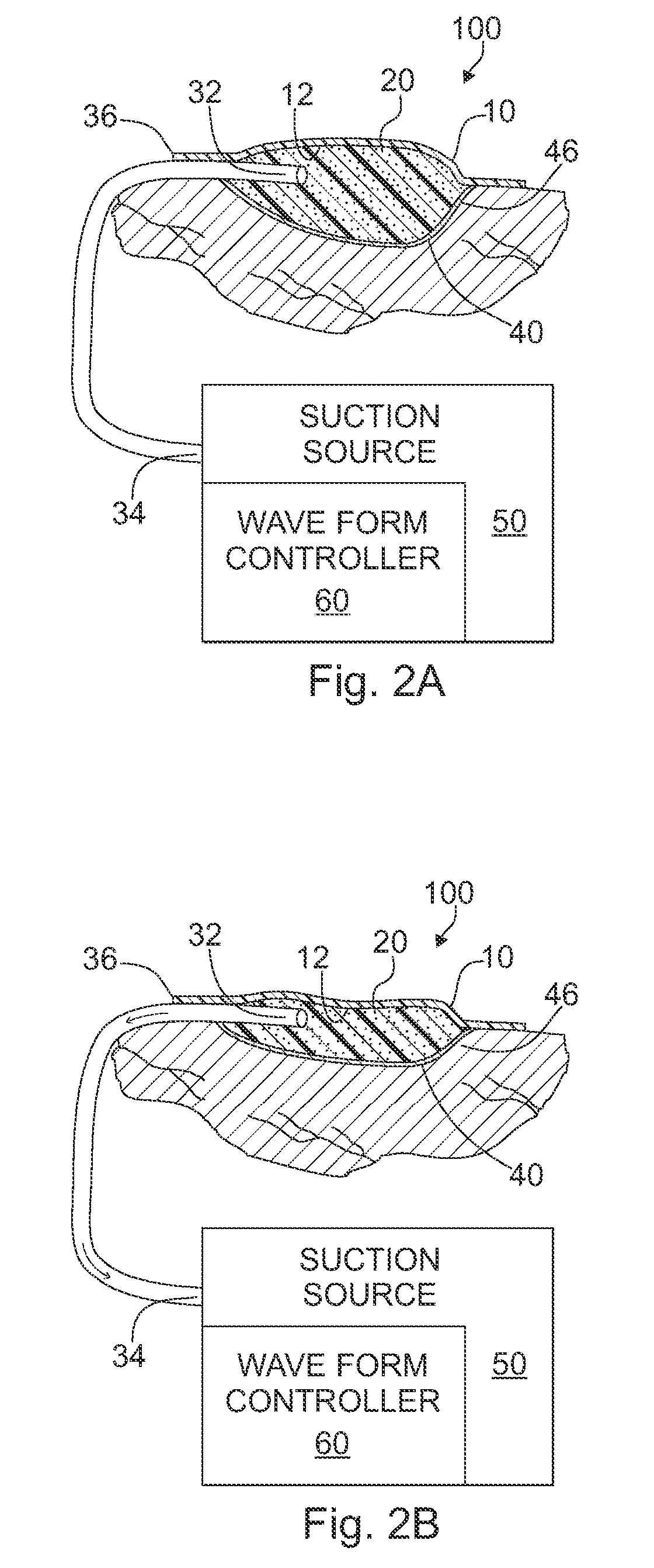 Apparatus and method for wound treatment employing periodic sub-atmospheric pressure