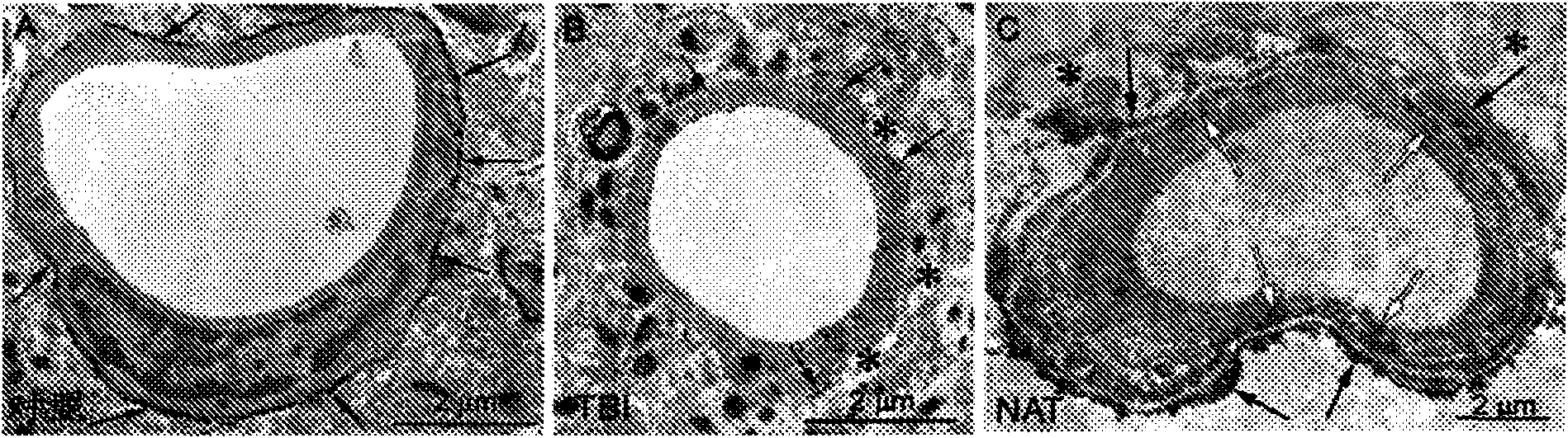 Method for reducing intracranial pressure