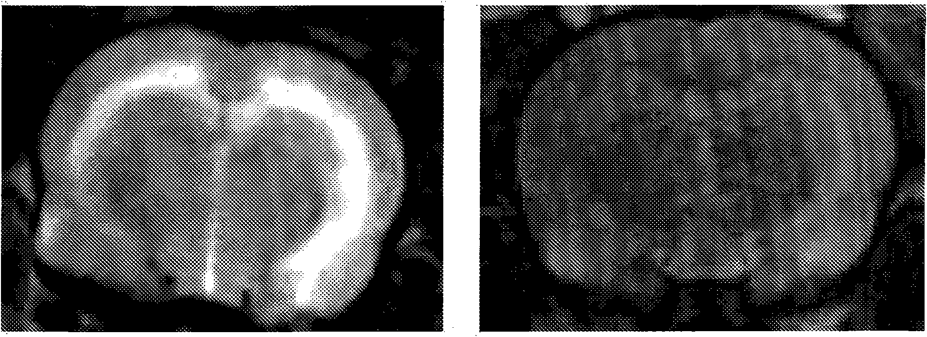 Method for reducing intracranial pressure