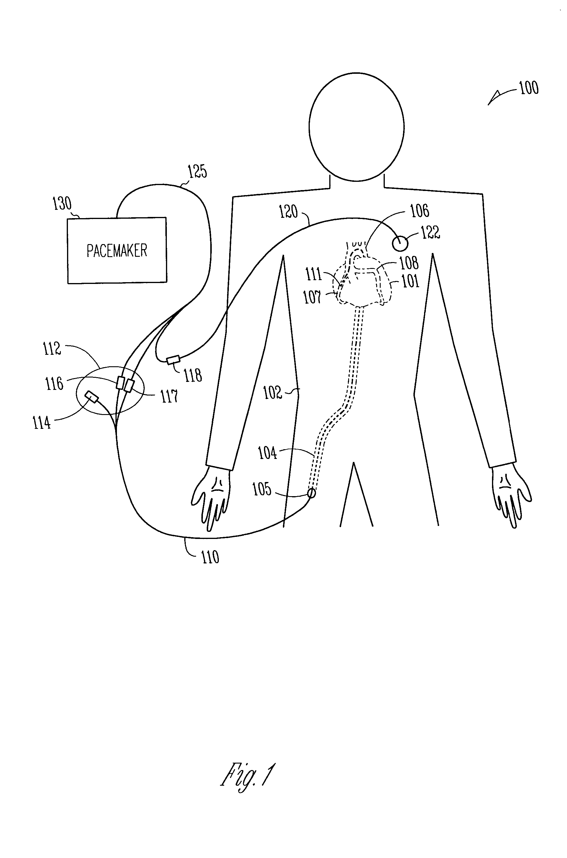 Method and apparatus for pacing during revascularization